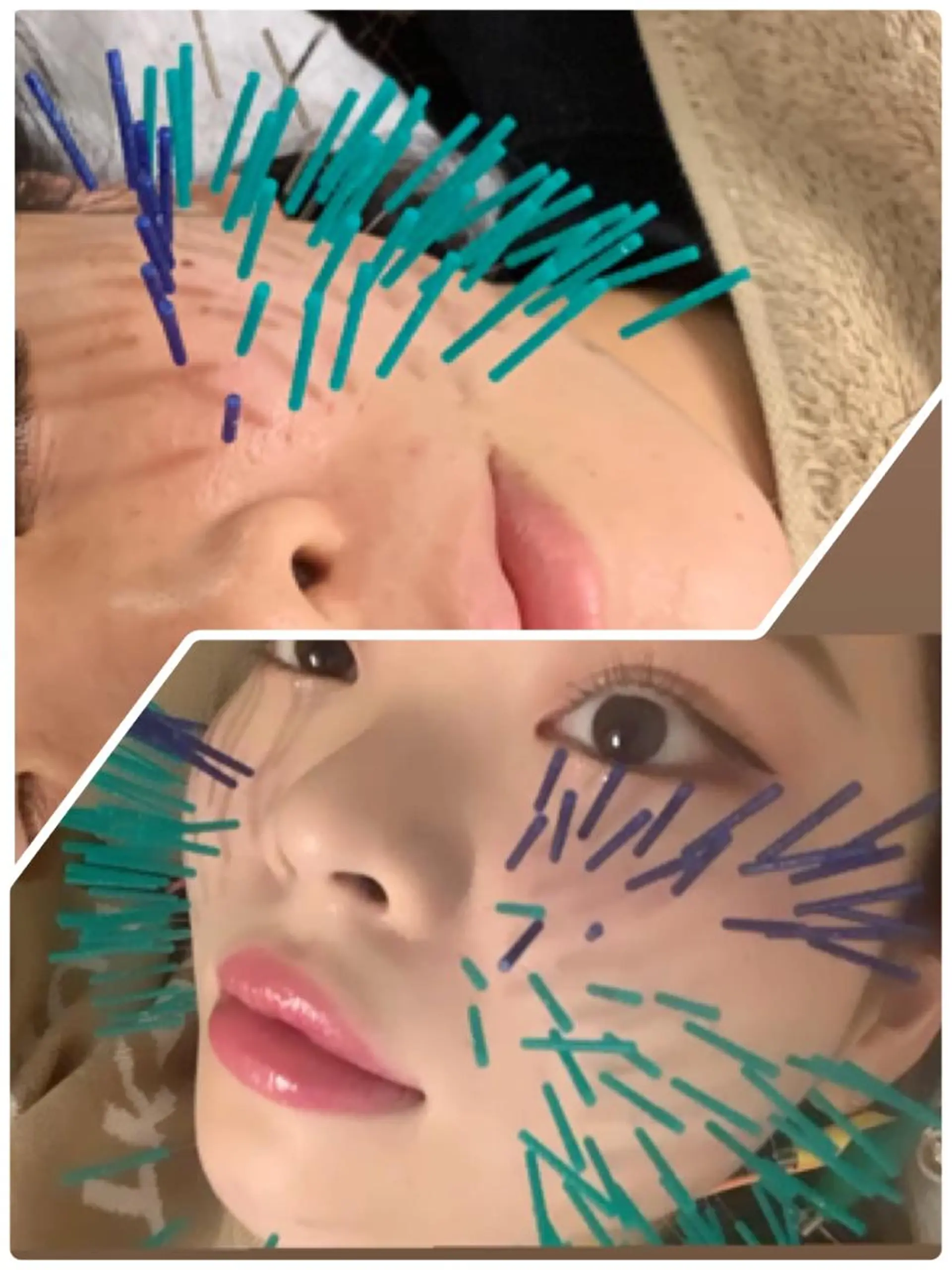 表参道鍼灸院K 美容鍼🔮ララピールのエステ・リラクイメージ