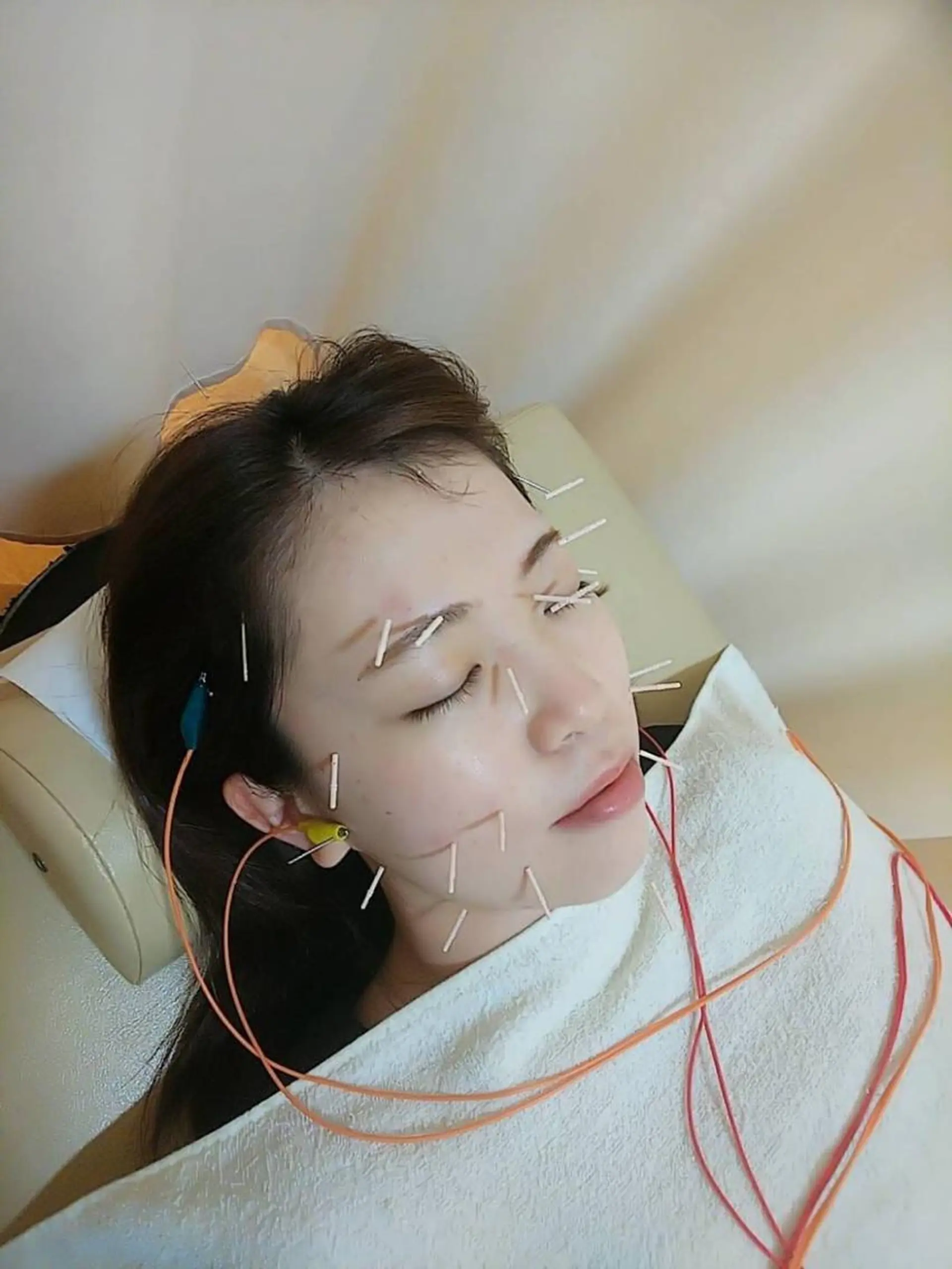 リフトアップ・たるみ ☆美容鍼小顔矯正のその他イメージ