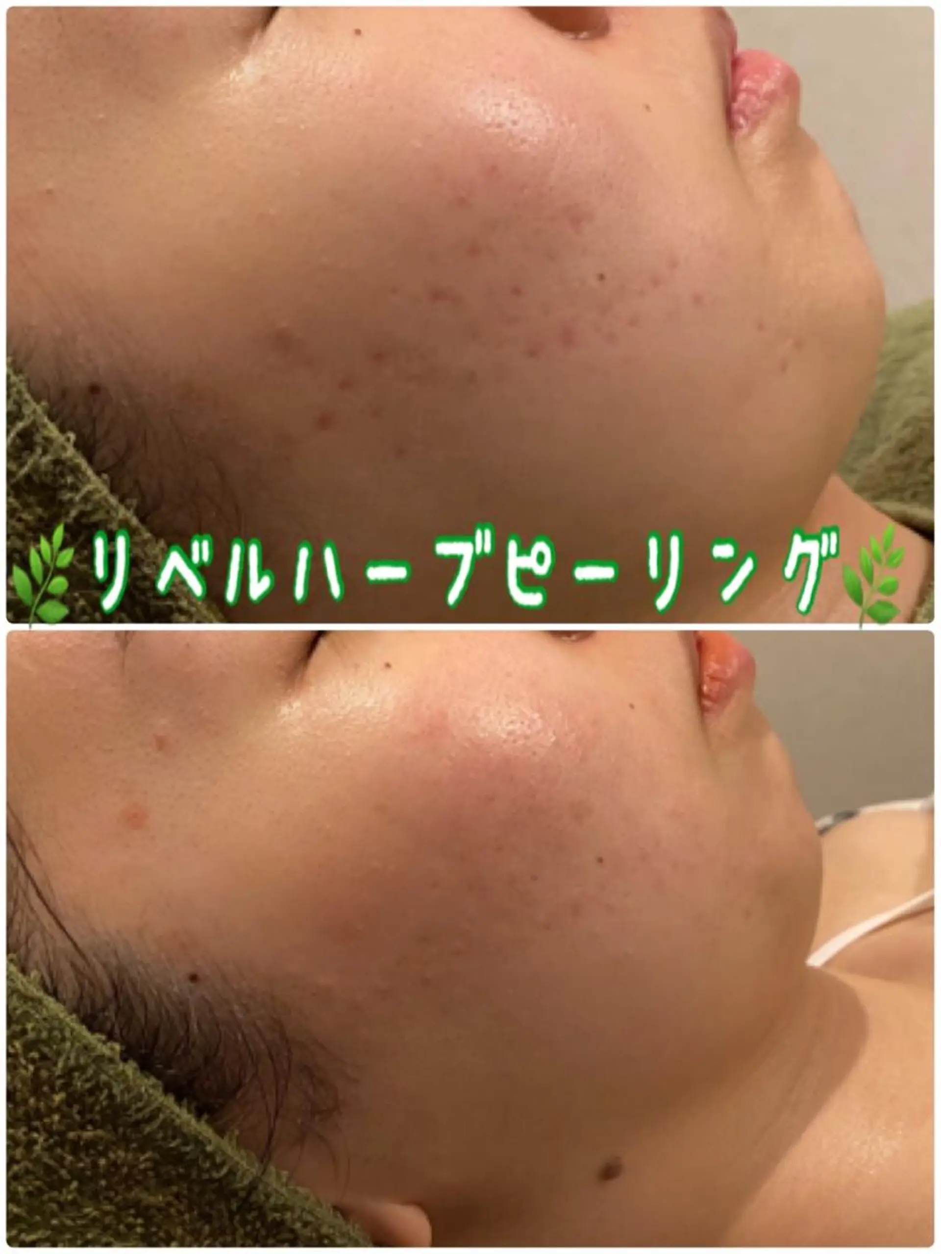 エステ 【リベルハーブピーリング認定店】敏感肌・美白脱毛専門店Dione立川店所属・Dione 立川店のエステ・リラクイメージ