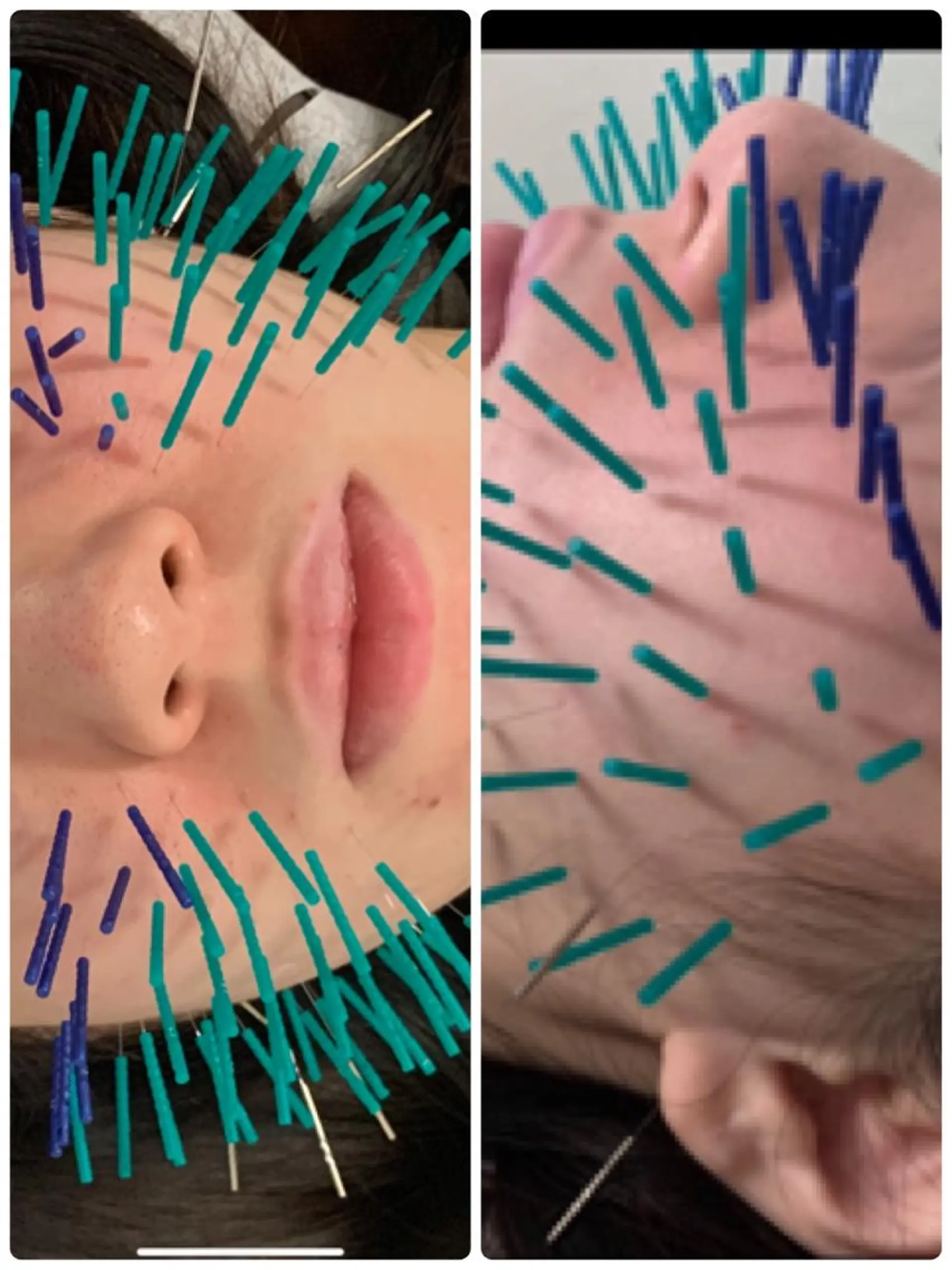 表参道鍼灸院K 美容鍼🔮ララピールのエステ・リラクイメージ