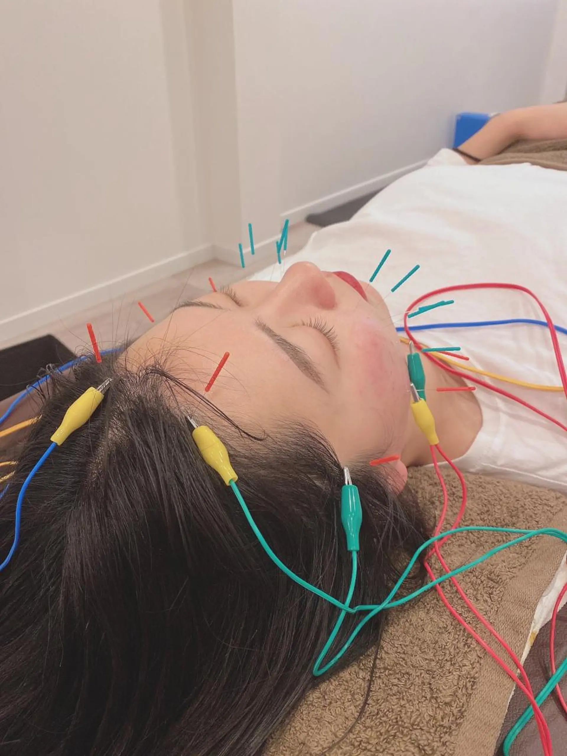 エステ リラク 美容鍼灸Solana所属・肌質改善×美容鍼 ゆいのエステ・リラクイメージ