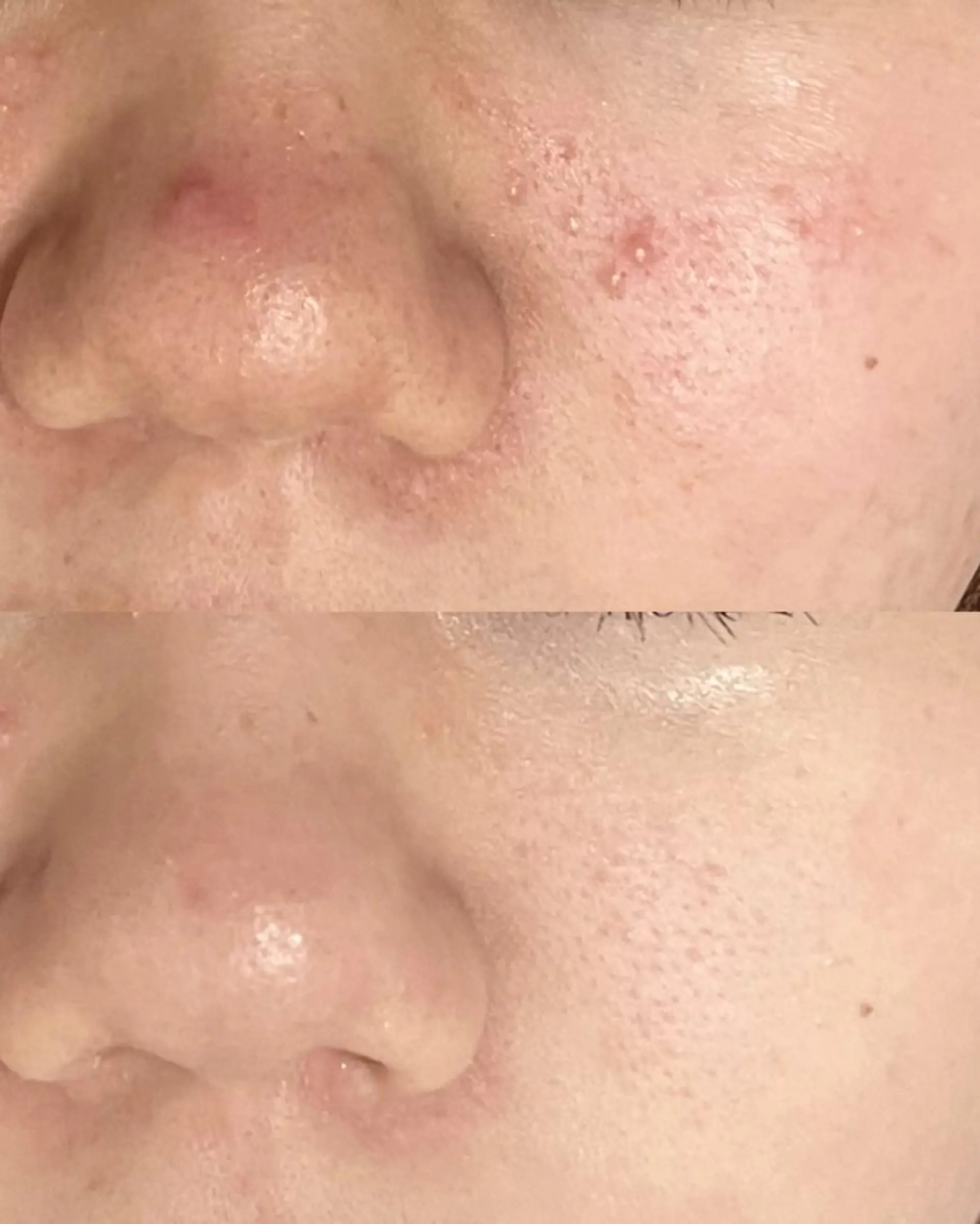 エステ リラク ニキビ跡改善専門🔥 医療にはできない改善のエステ・リラクイメージ