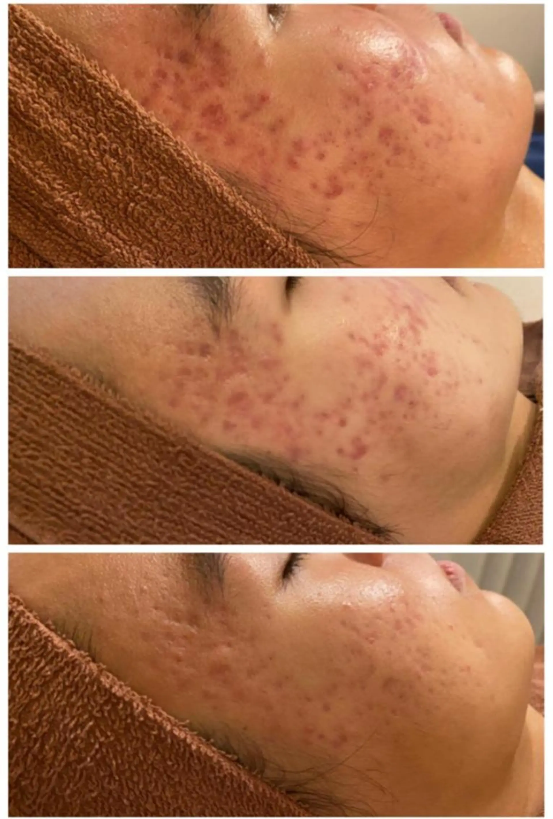 夏までに肌荒れ卒業 するサロン🌻のエステ・リラクイメージ