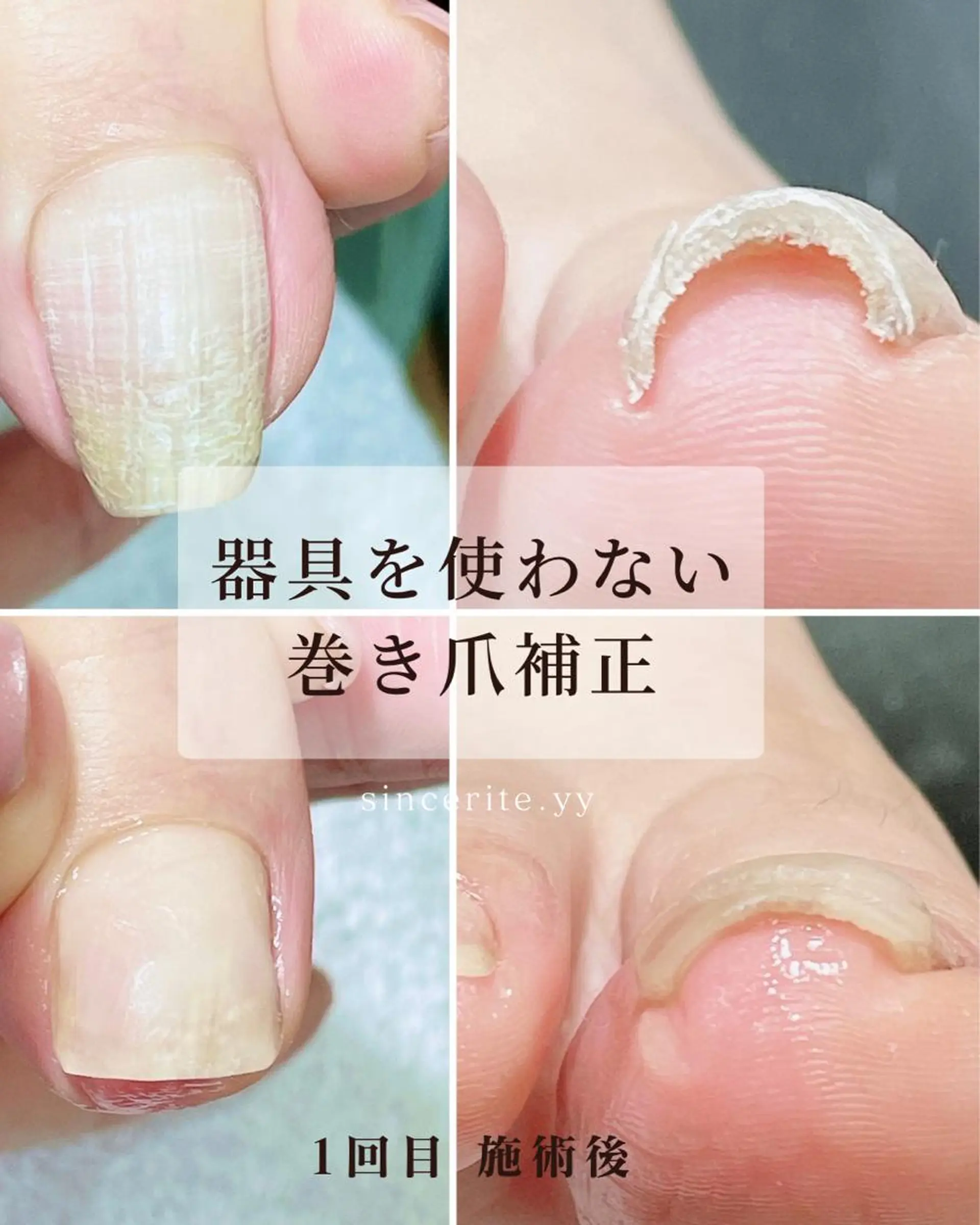 ネイル 深爪・巻き爪 専門サンセリテのネイルデザイン