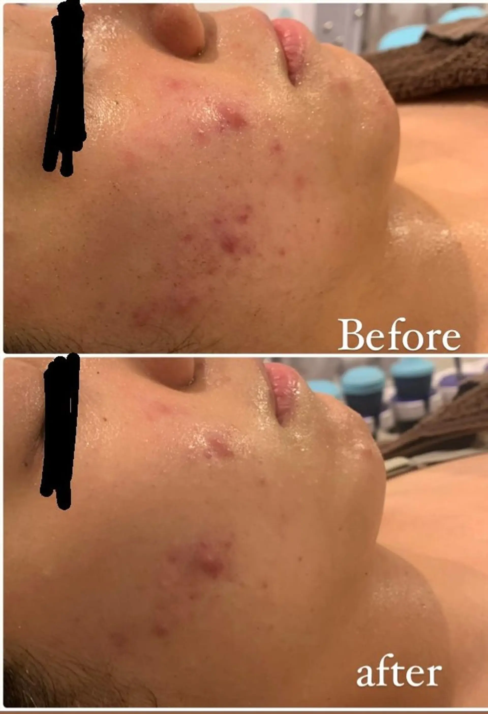 肌質改善ハーブピー リング🌿RINAのエステ・リラクイメージ