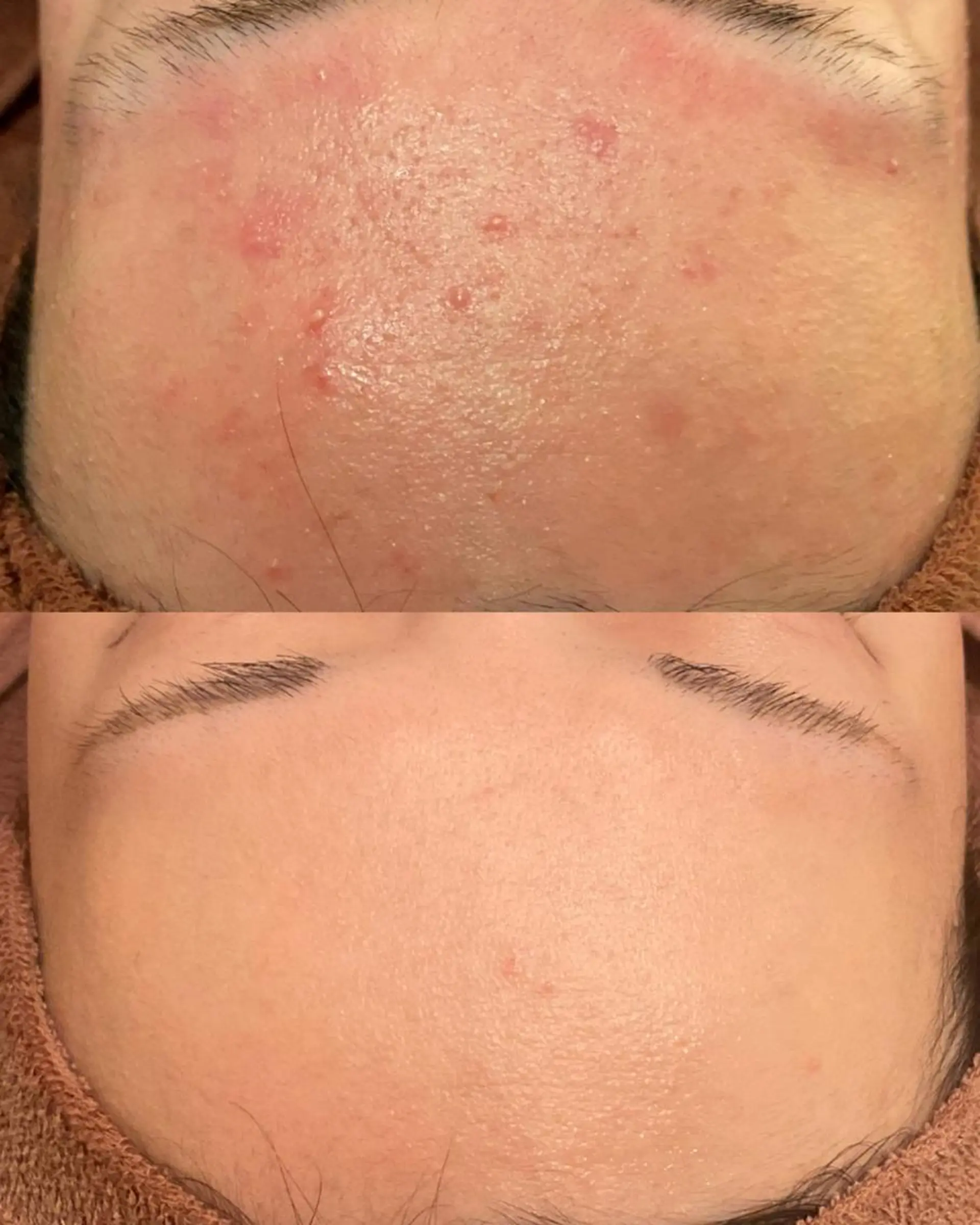 エステ リラク 6万人の美肌実績🔥 最短ニキビ改善のエステ・リラクイメージ