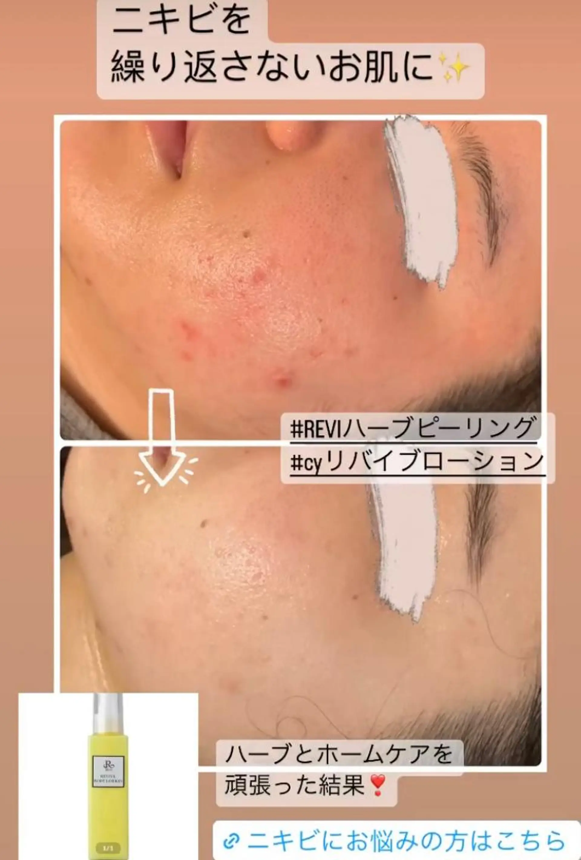 エステ luana beauty所属・kana ハーブピーリング🌿のエステ・リラクイメージ