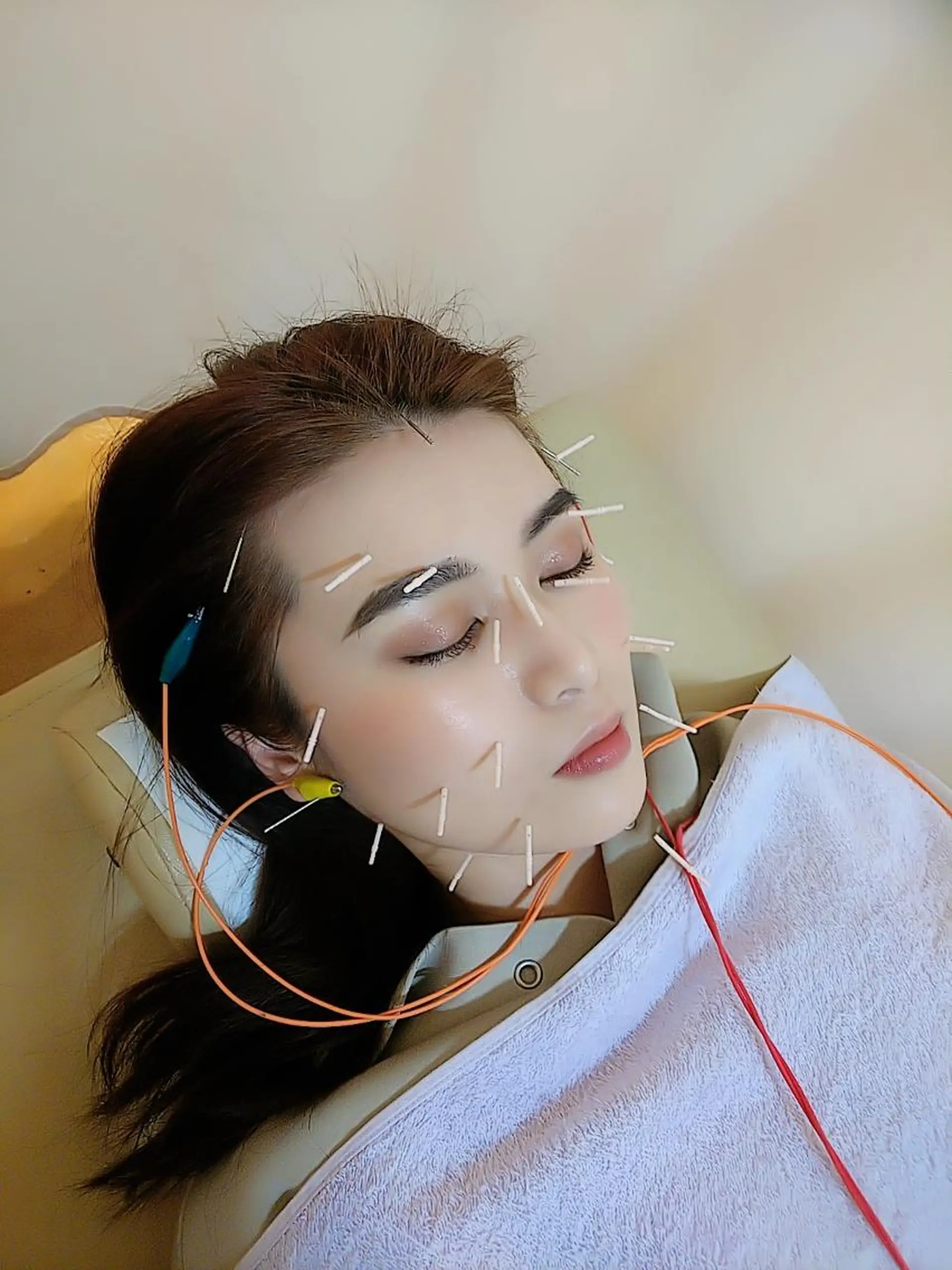 リフトアップ・たるみ ☆美容鍼小顔矯正のその他イメージ