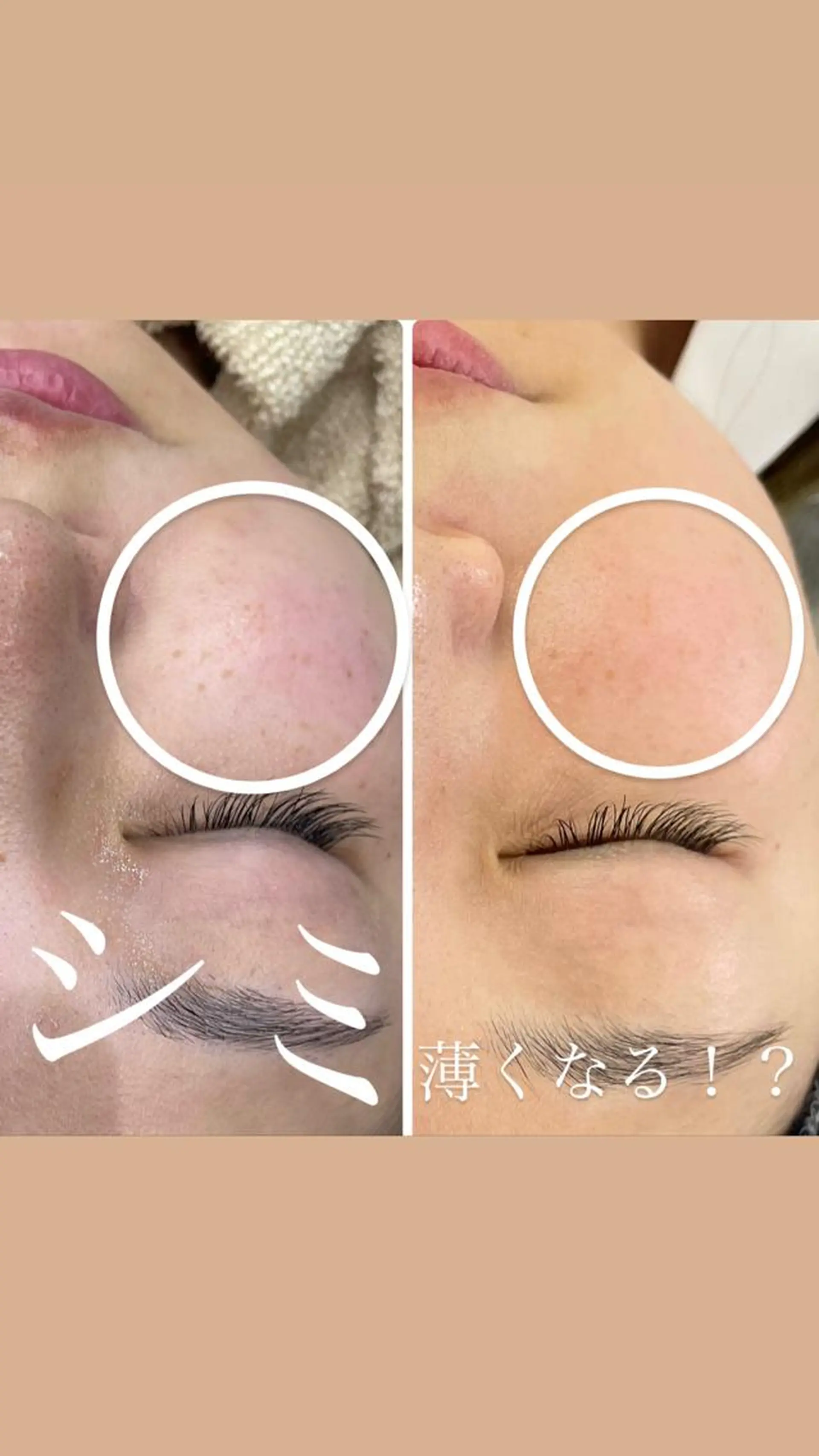 ニキビ・毛穴改善 🌿ハーブピーリングのエステ・リラクイメージ