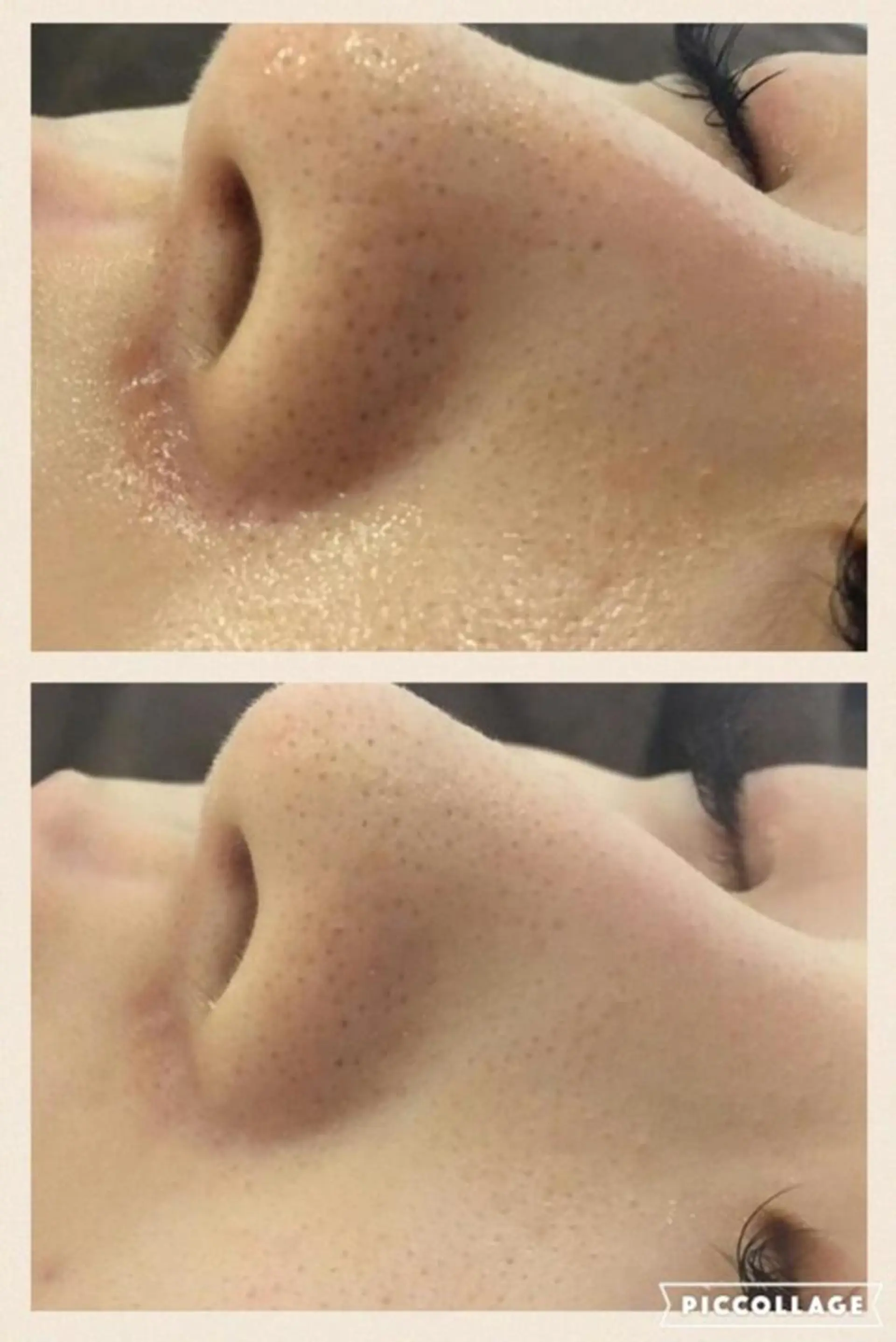 🔥3か月で肌革命 🔥ニキビ専門店のエステ・リラクイメージ