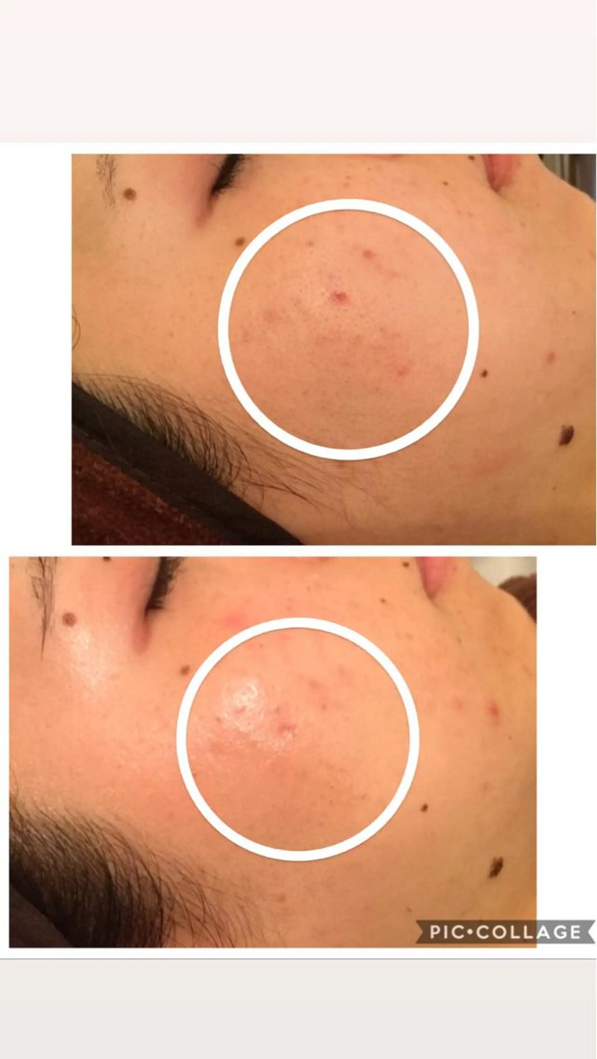 エステ リラク ニキビ/肌質改善専門 Snow skinのエステ・リラクイメージ