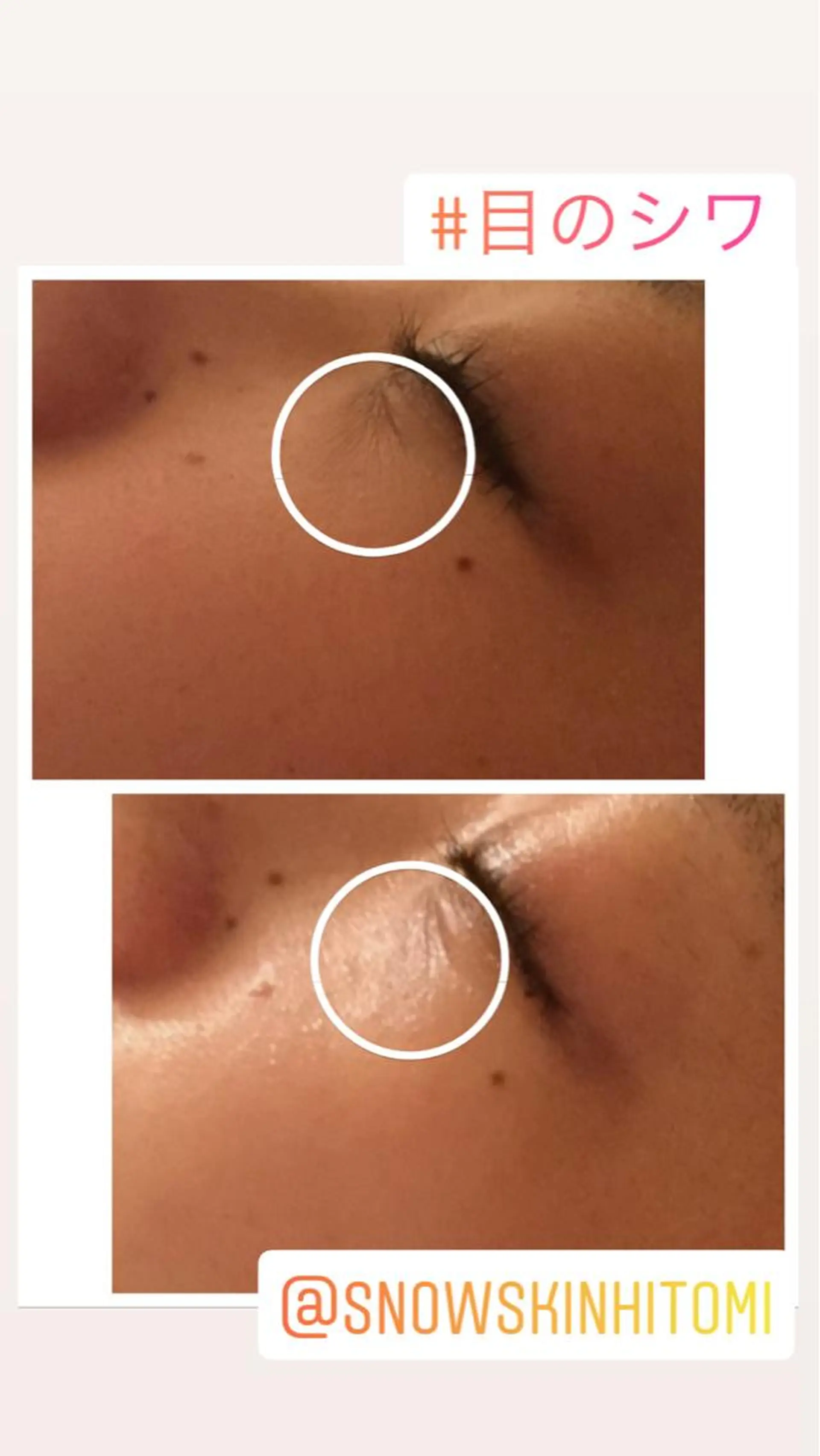 エステ リラク ニキビ/肌質改善専門 Snow skinのエステ・リラクイメージ