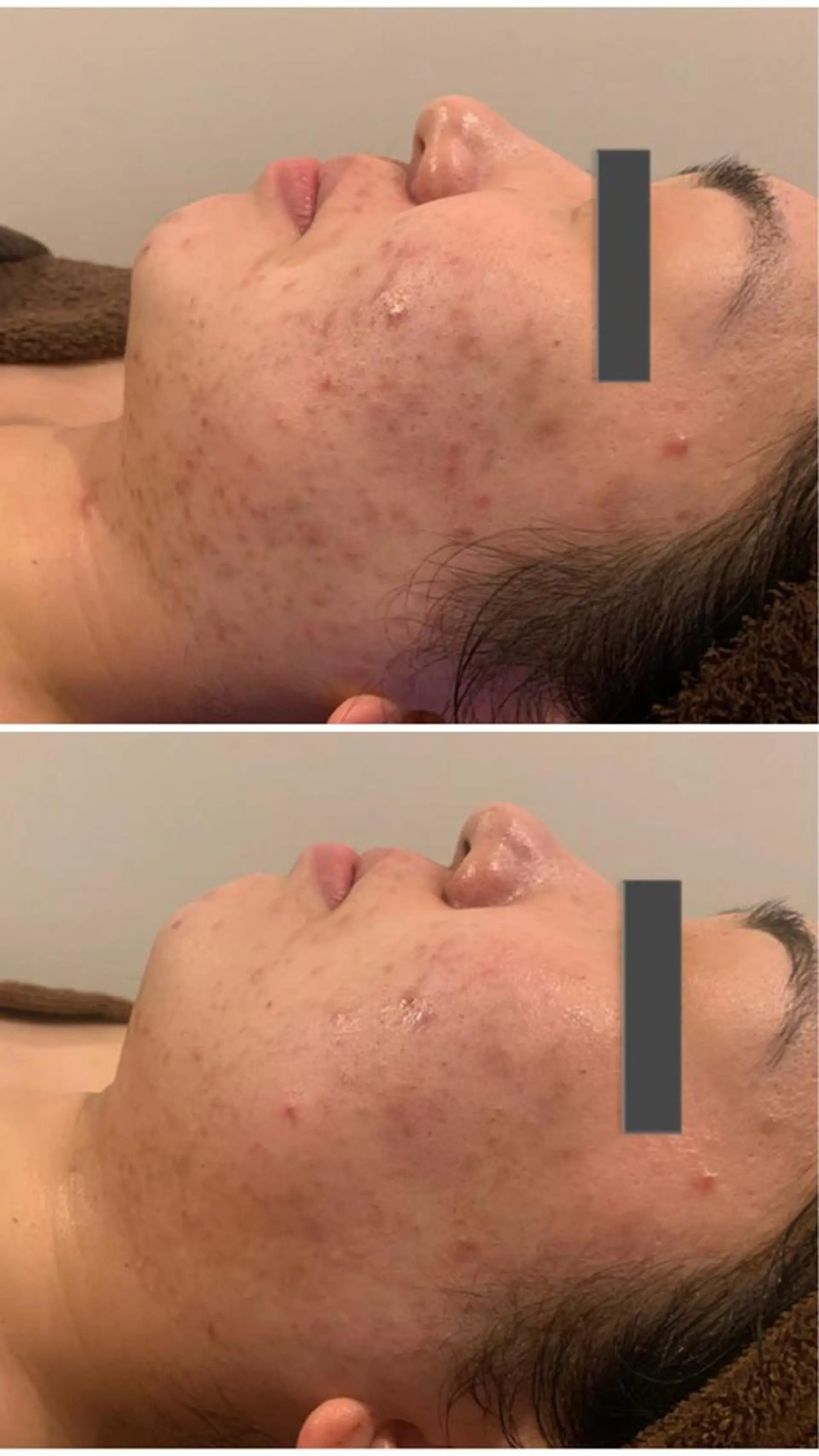 肌質改善ハーブピー リング🌿RINAのエステ・リラクイメージ