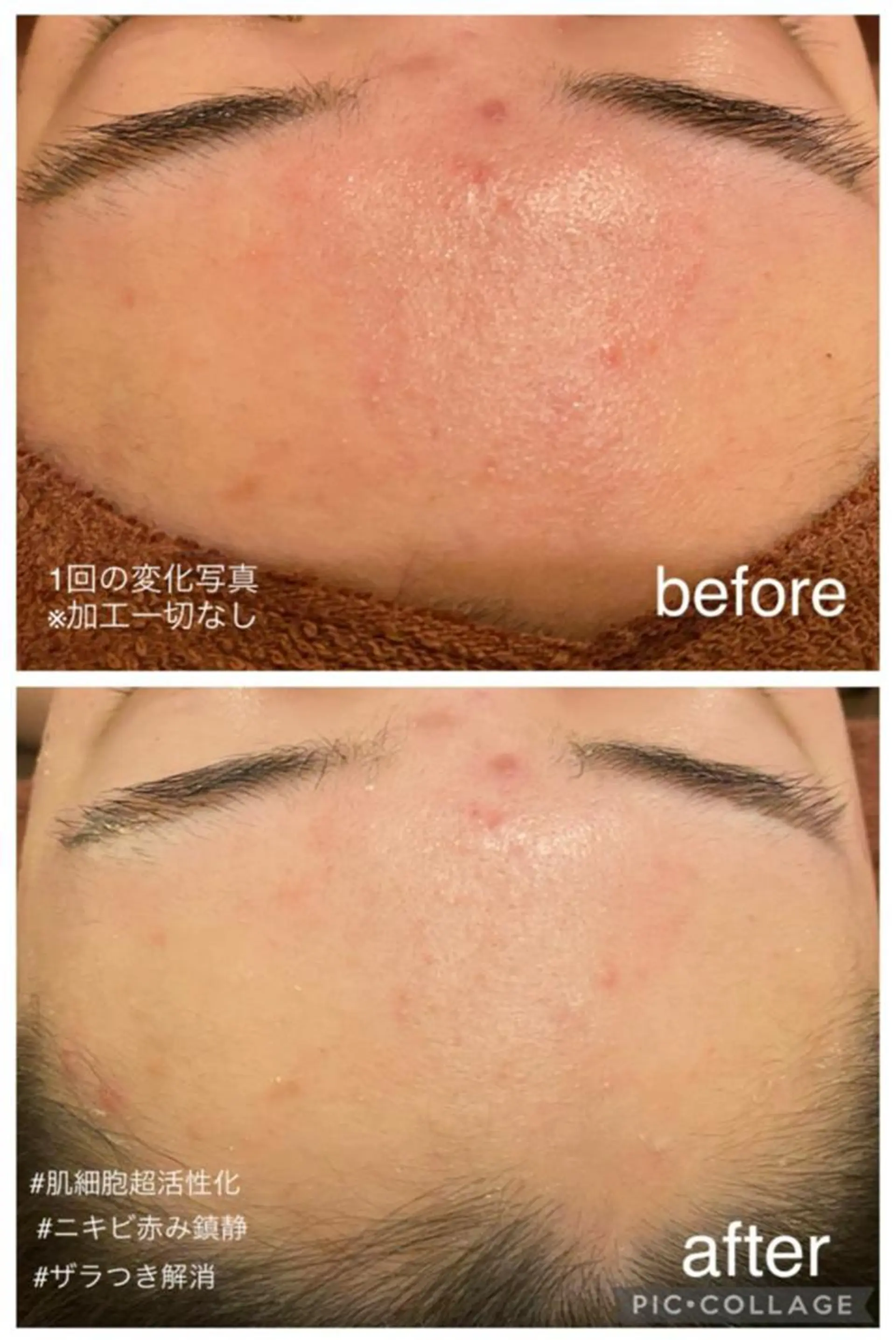 🔥3か月で肌革命 🔥ニキビ専門店のエステ・リラクイメージ