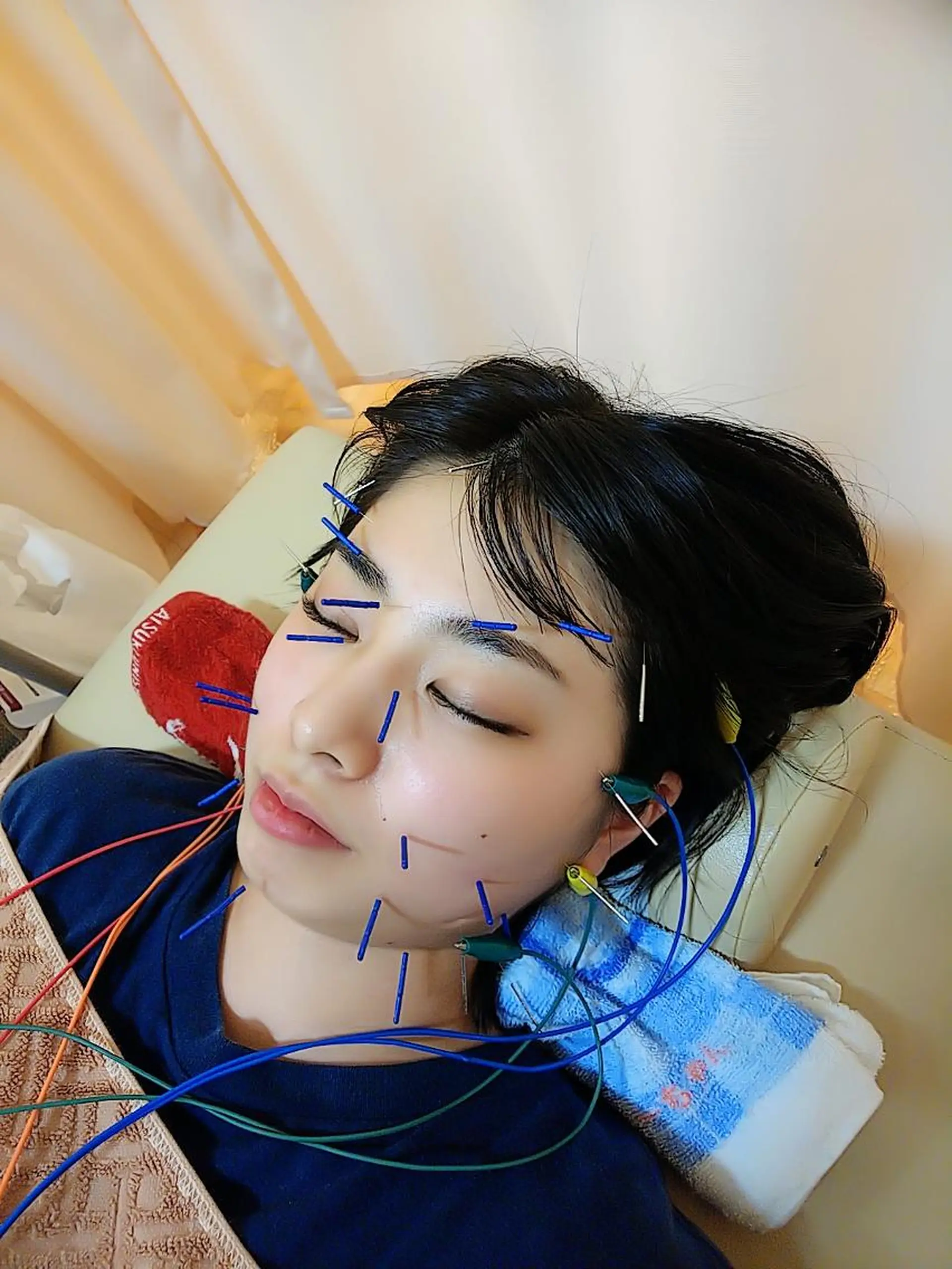 リフトアップ・たるみ ☆美容鍼小顔矯正のその他イメージ