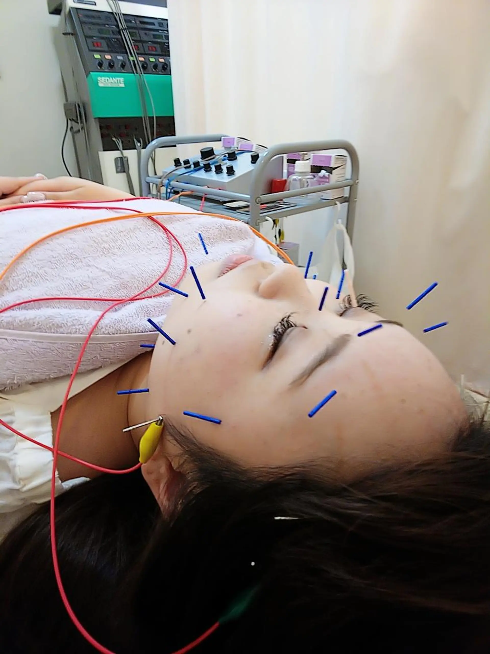 リフトアップ・たるみ ☆美容鍼小顔矯正のその他イメージ