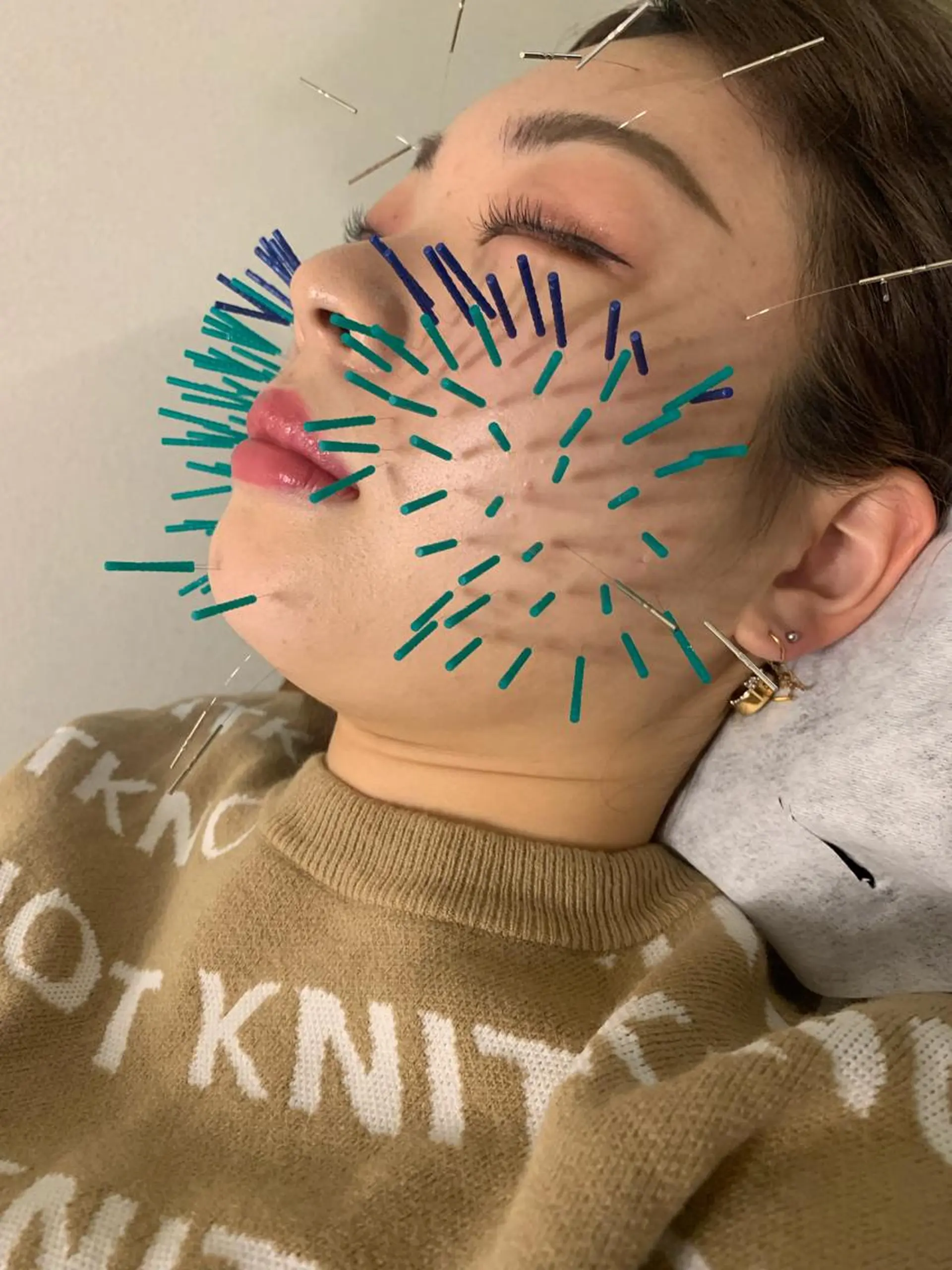 表参道鍼灸院K 美容鍼🔮ララピールのエステ・リラクイメージ