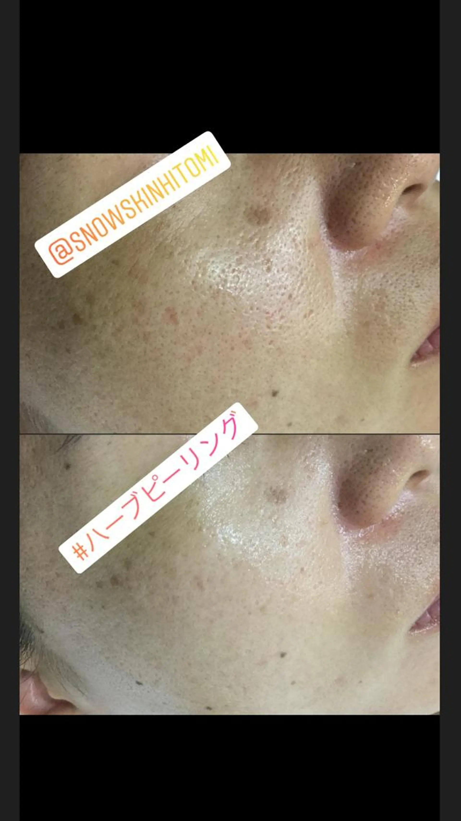 ニキビ/肌質改善専門 Snow skinのエステ・リラクイメージ