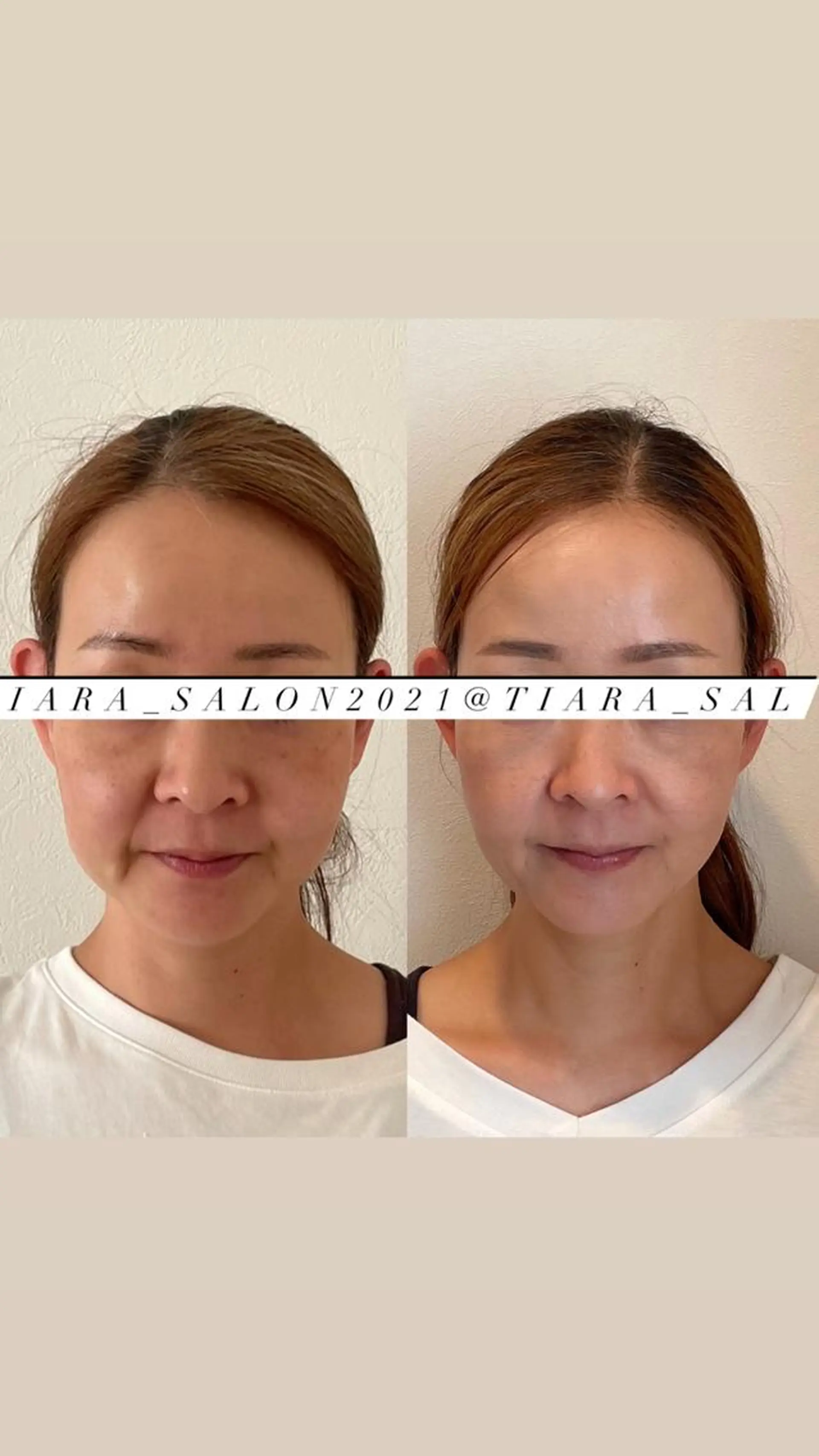 美容鍼灸サロン　TIARA所属・鍼灸サロン TIARA　美容鍼のエステ・リラクイメージ