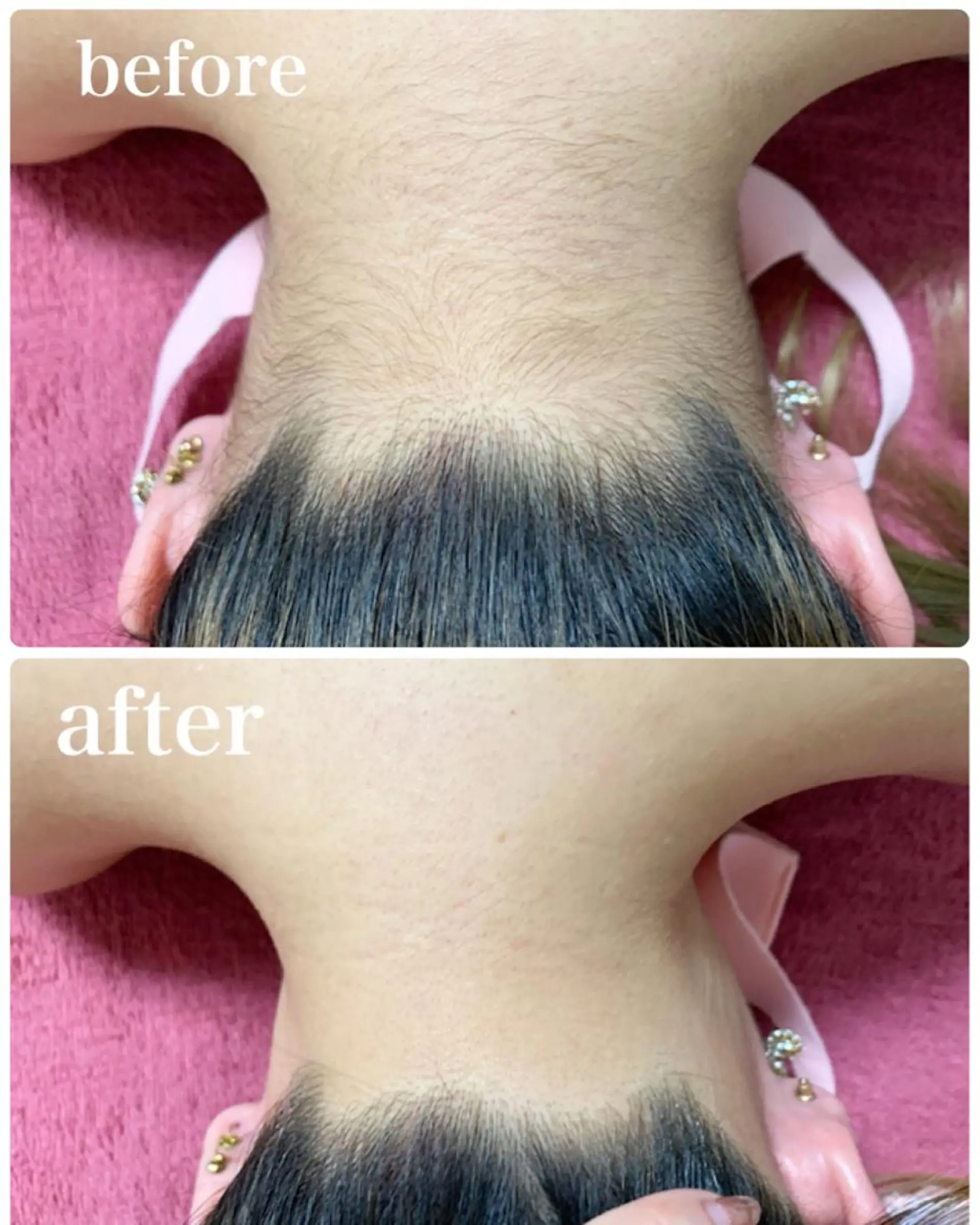 脱毛 grantier beautyのネイルデザイン