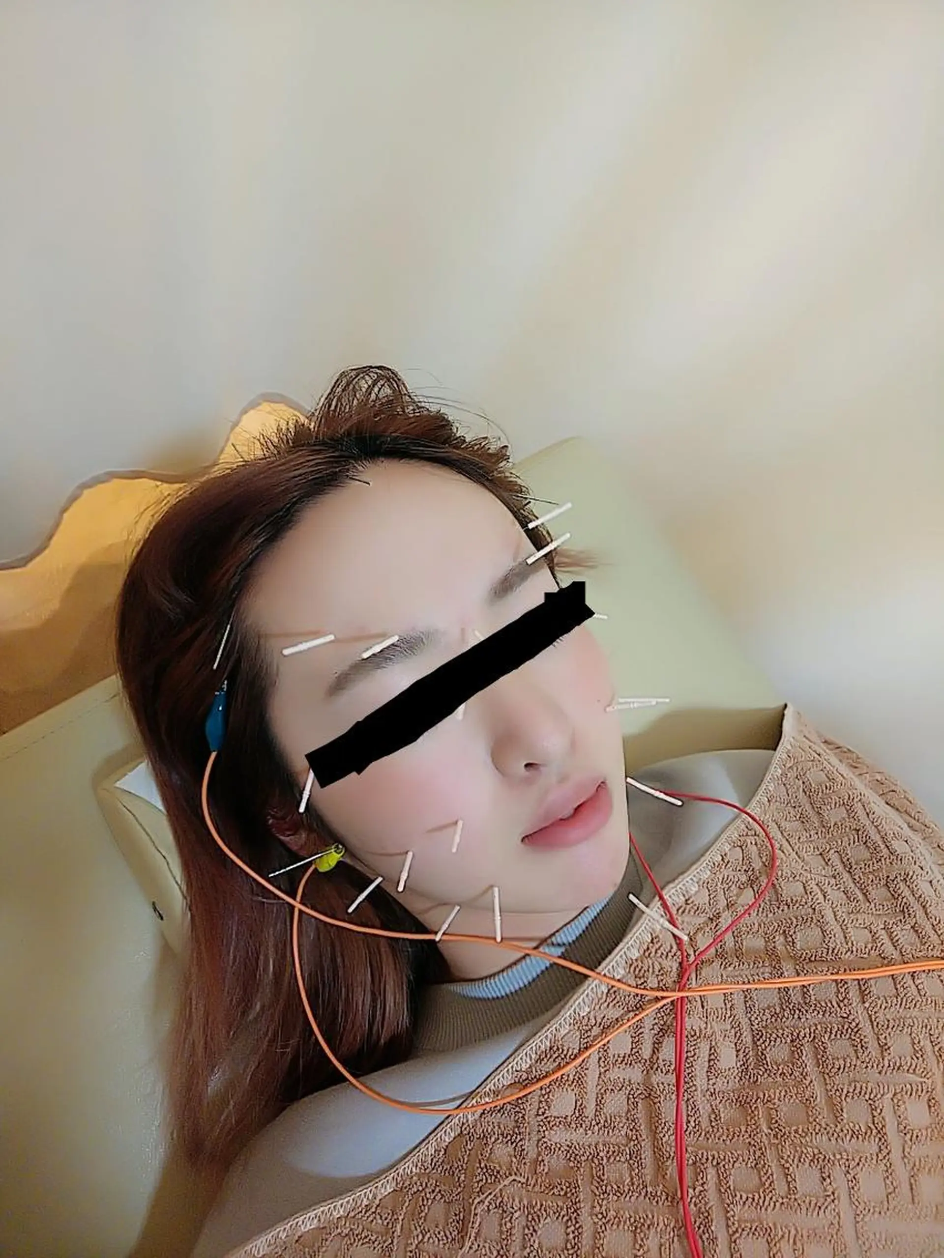 リフトアップ・たるみ ☆美容鍼小顔矯正のその他イメージ