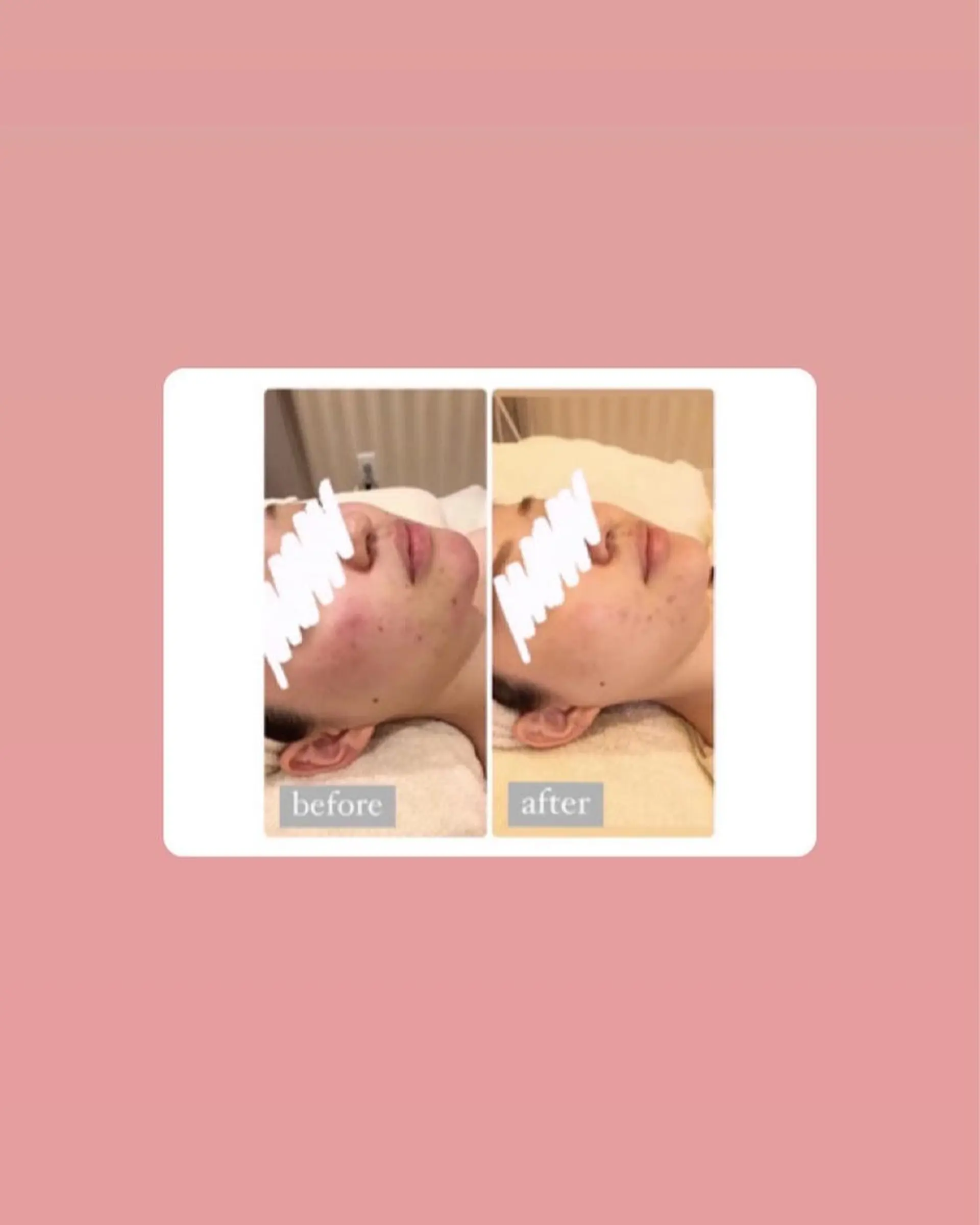 脱毛 ULULU上野店所属・ULULU 上野店のエステ・リラクイメージ