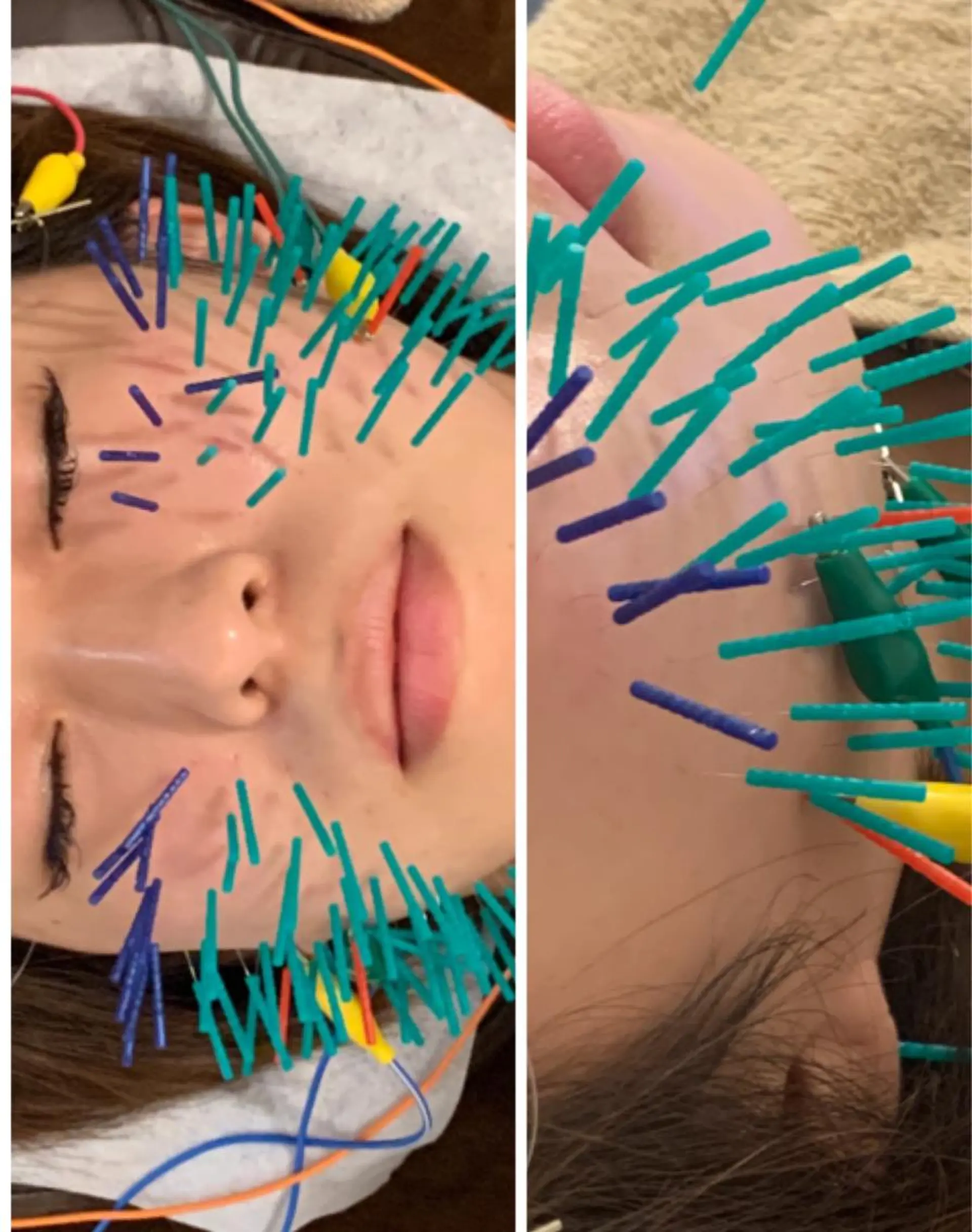 表参道鍼灸院K 美容鍼🔮ララピールのエステ・リラクイメージ