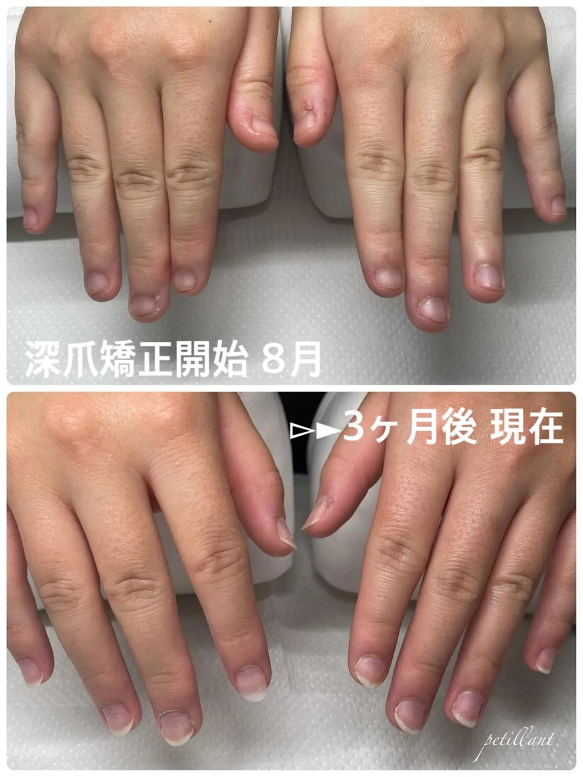 ネイル 長さ出し ピンク petillant所属・nail salon petillantのネイルデザイン