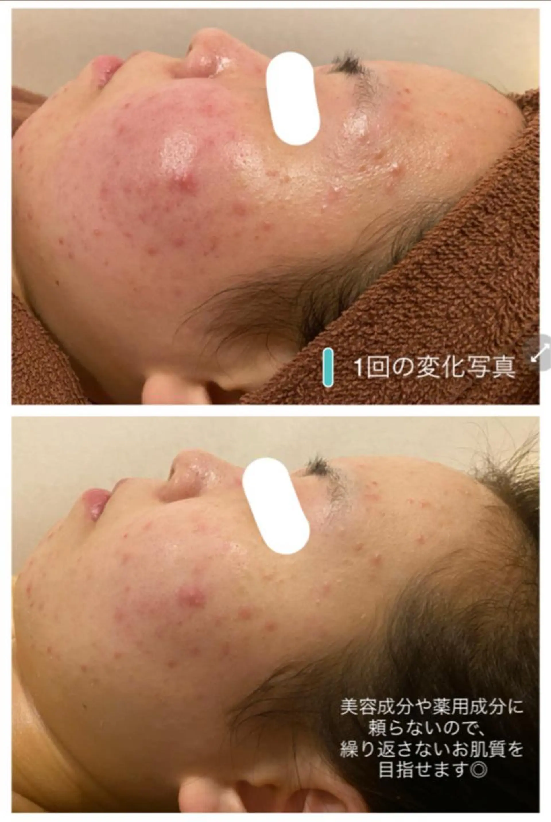 ニキビ跡改善専門🔥 医療にはできない改善のエステ・リラクイメージ