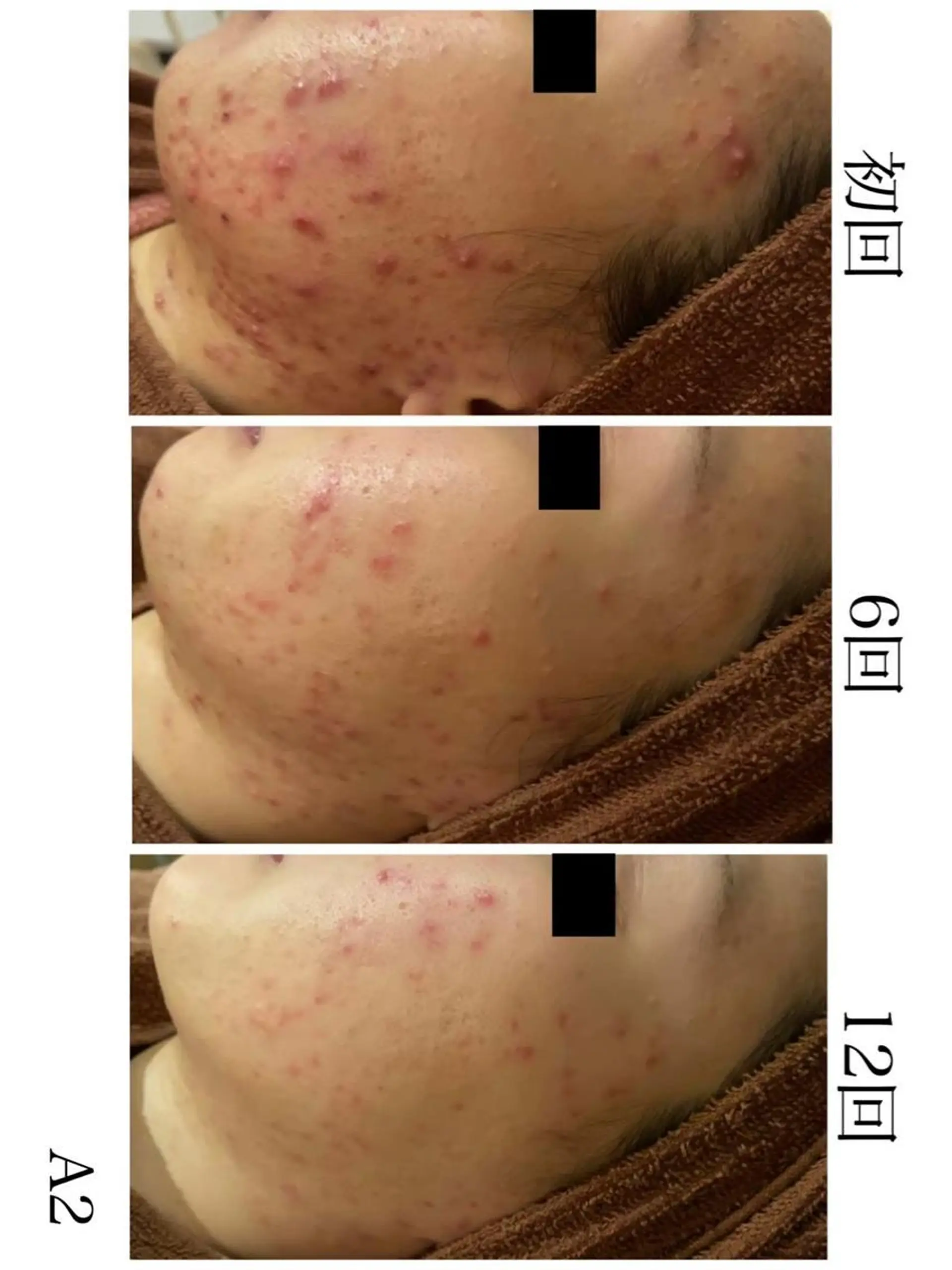 ロング カラー パーマ ヘアアレンジ メンズ キッズ ネイル マツエク・マツパ アイブロウ 夏までに肌荒れ卒業 するサロン🌻のエステ・リラクイメージ