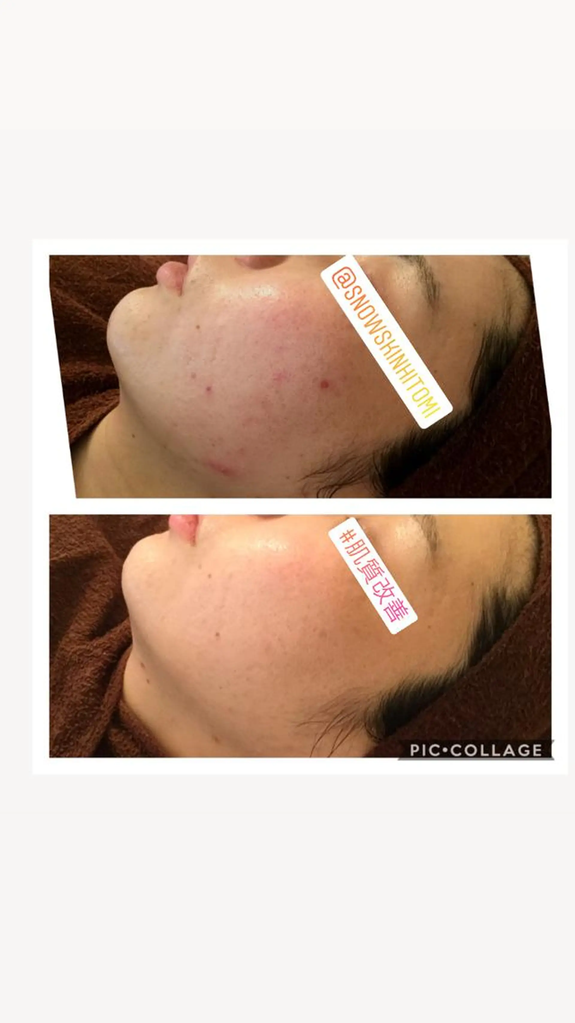 エステ リラク ニキビ/肌質改善専門 Snow skinのエステ・リラクイメージ