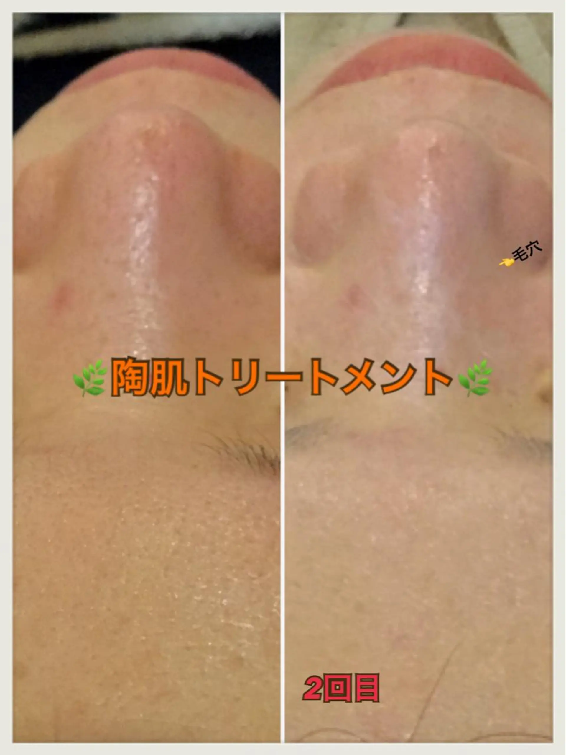 エステ 【リベルハーブピーリング認定店】敏感肌・美白脱毛専門店Dione立川店所属・Dione 立川店のエステ・リラクイメージ