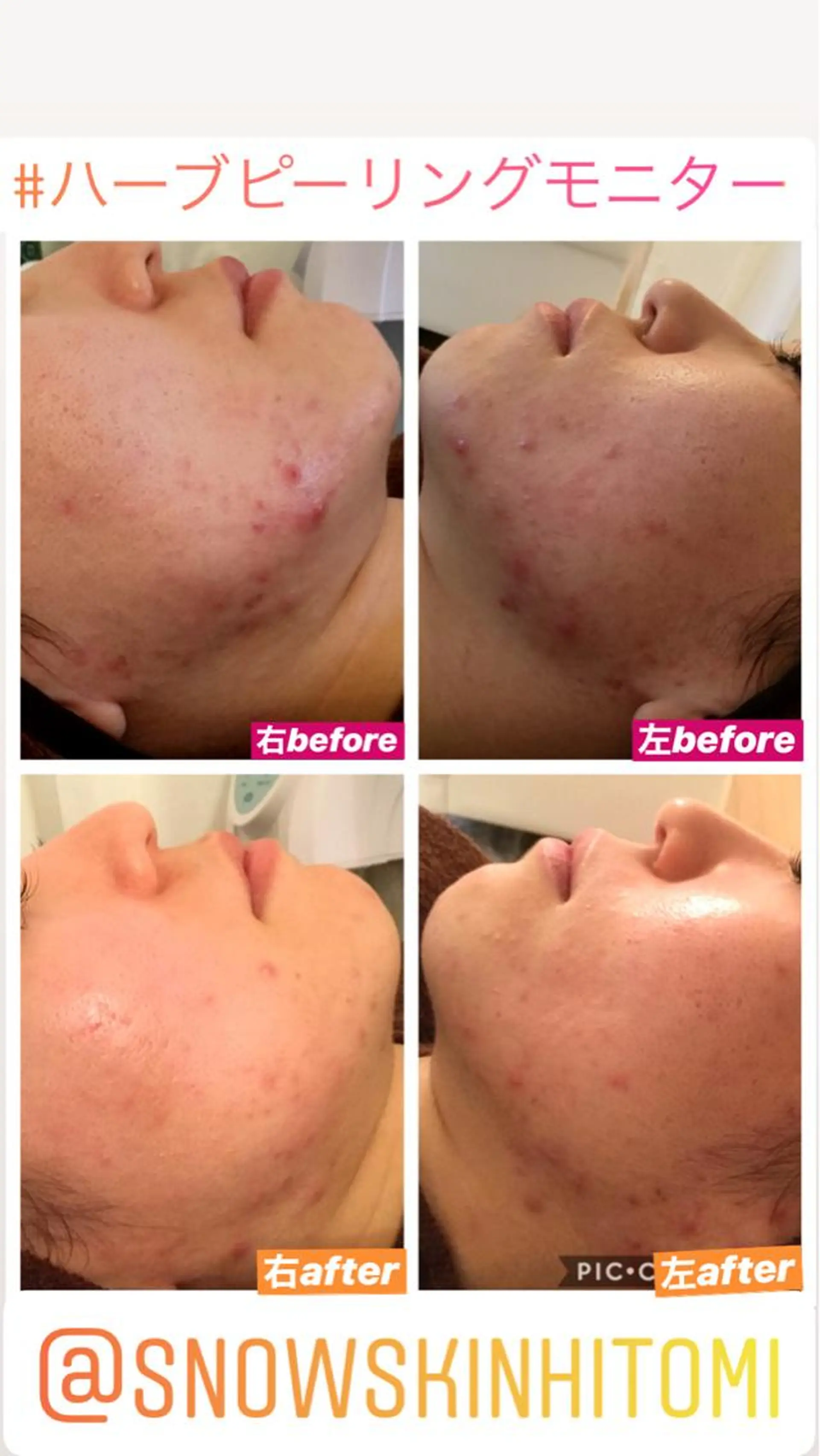 エステ リラク ニキビ/肌質改善専門 Snow skinのエステ・リラクイメージ