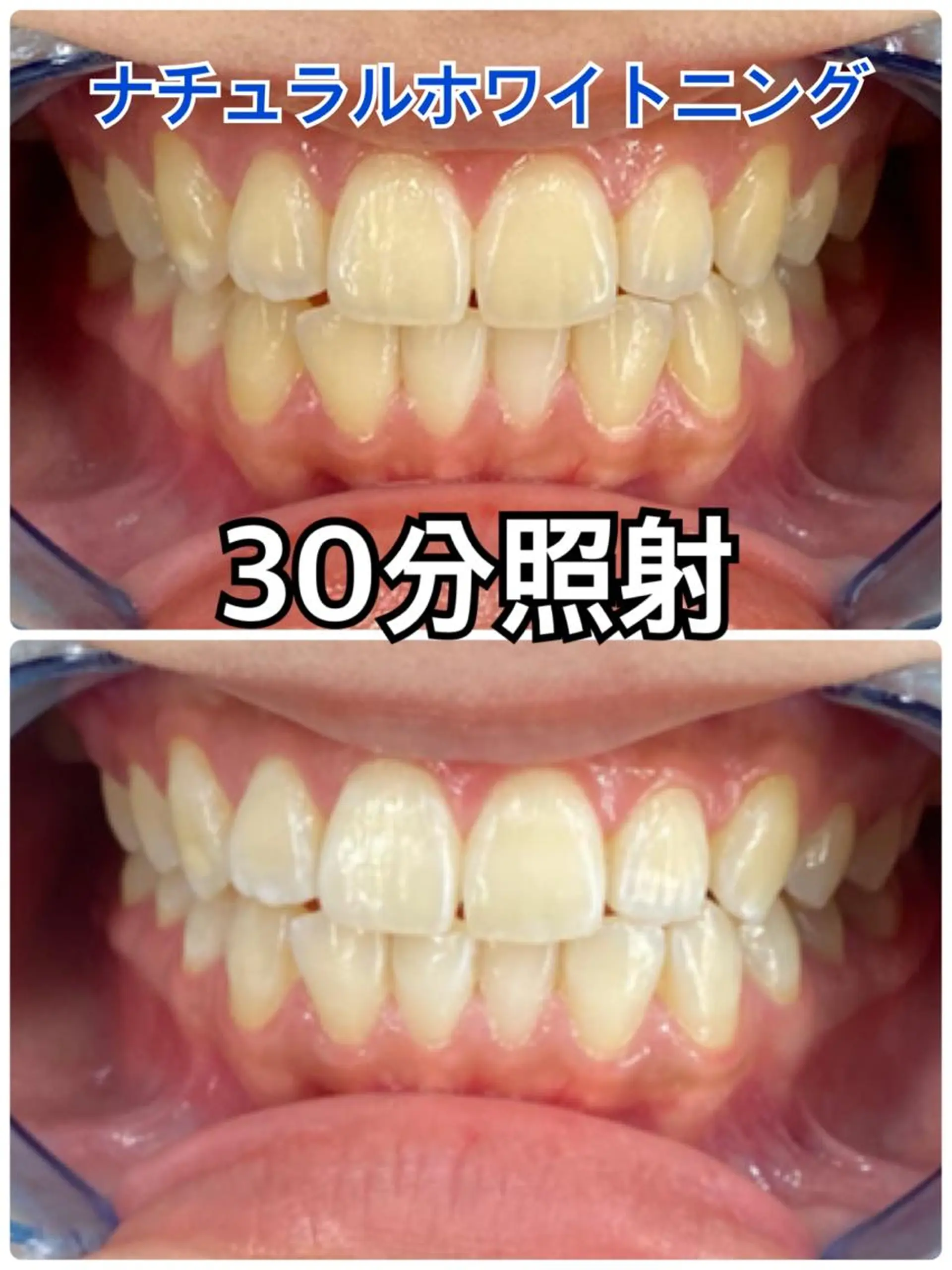 その他 Platinum Beauty 四条烏丸店所属・吉田亮利 ホワイトニング専門店のその他イメージ