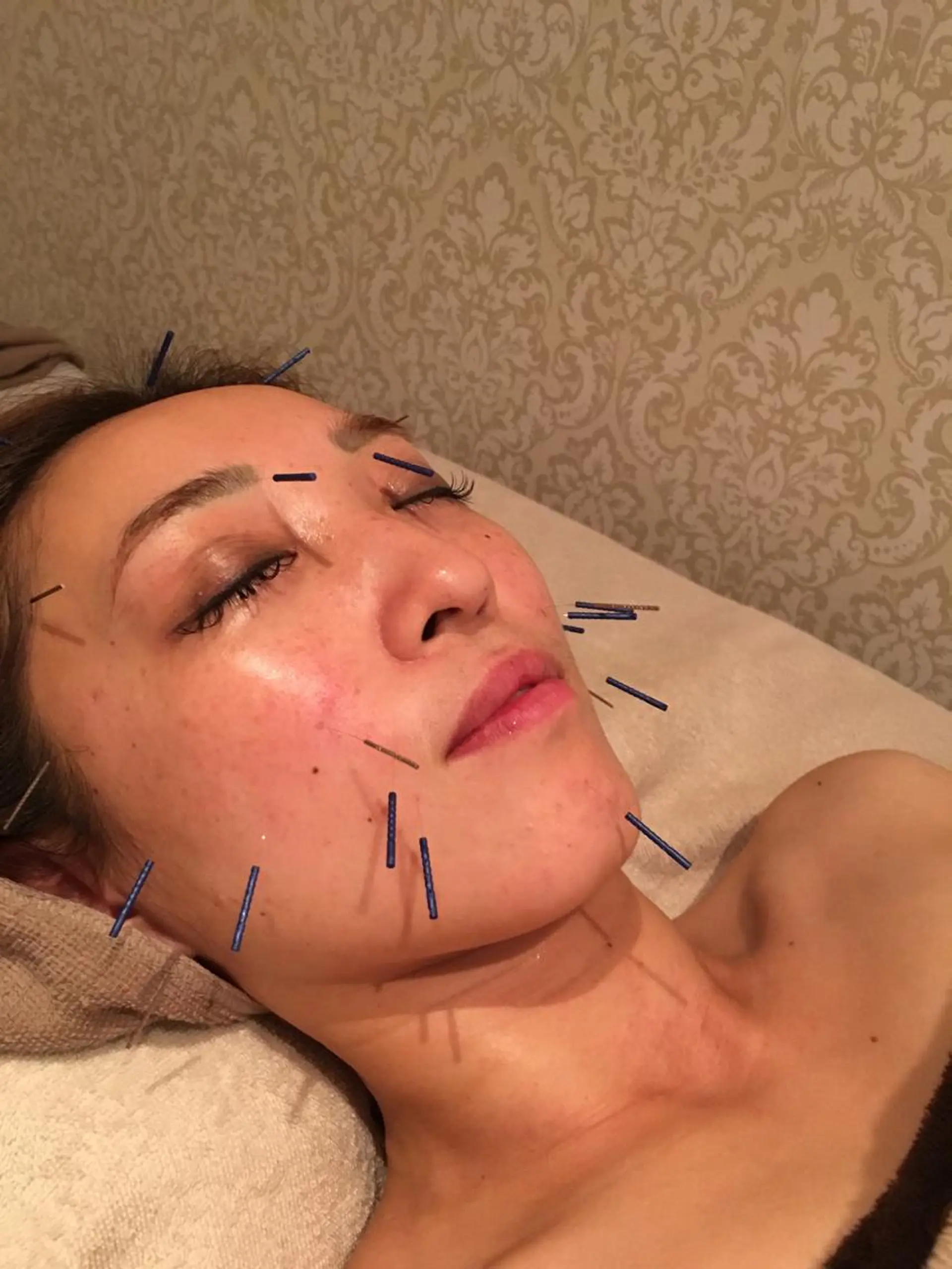 美容鍼サロン    Fleurir所属・伊藤 かなえのエステ・リラクイメージ