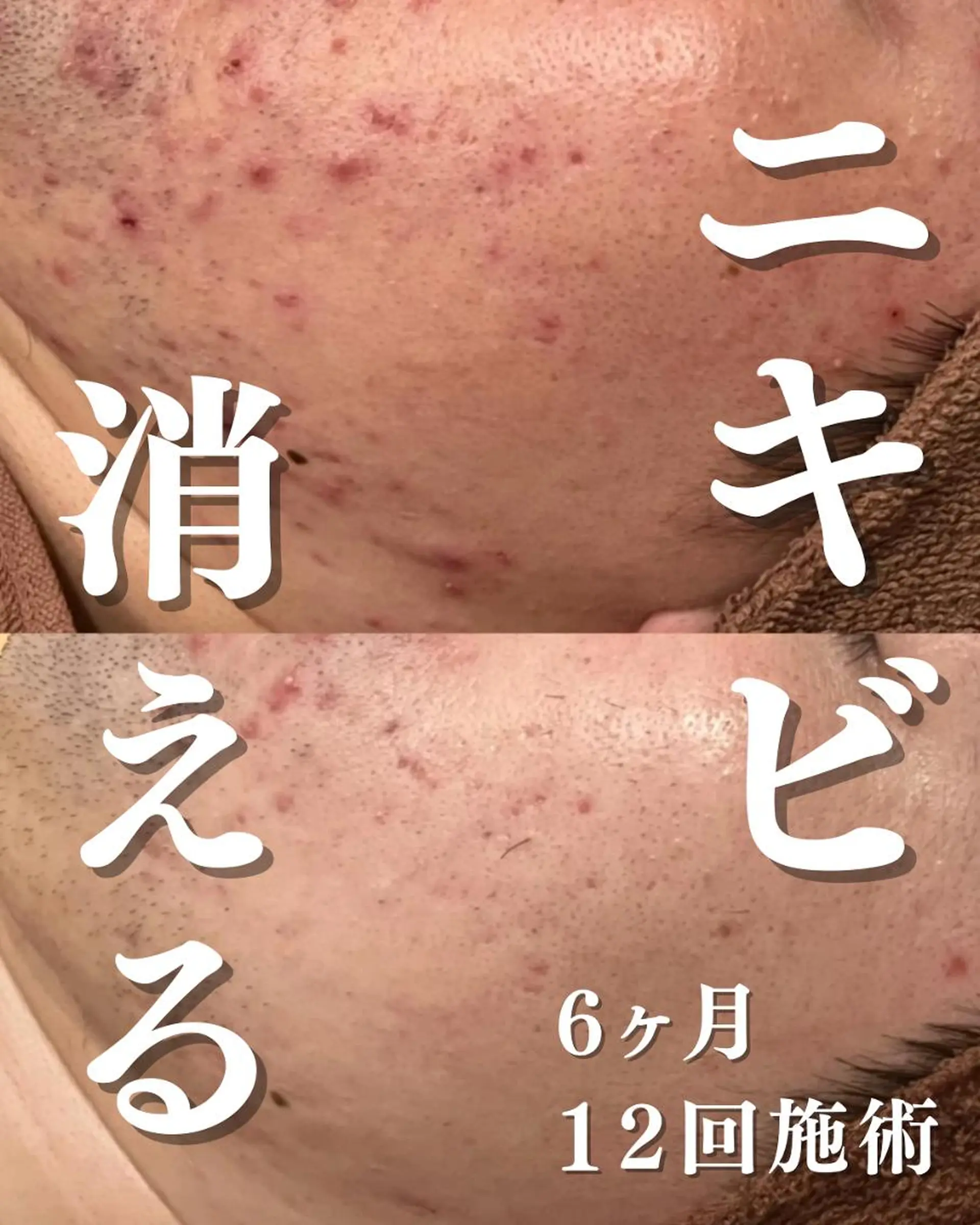 6万人の美肌実績🔥 最短ニキビ改善のエステ・リラクイメージ