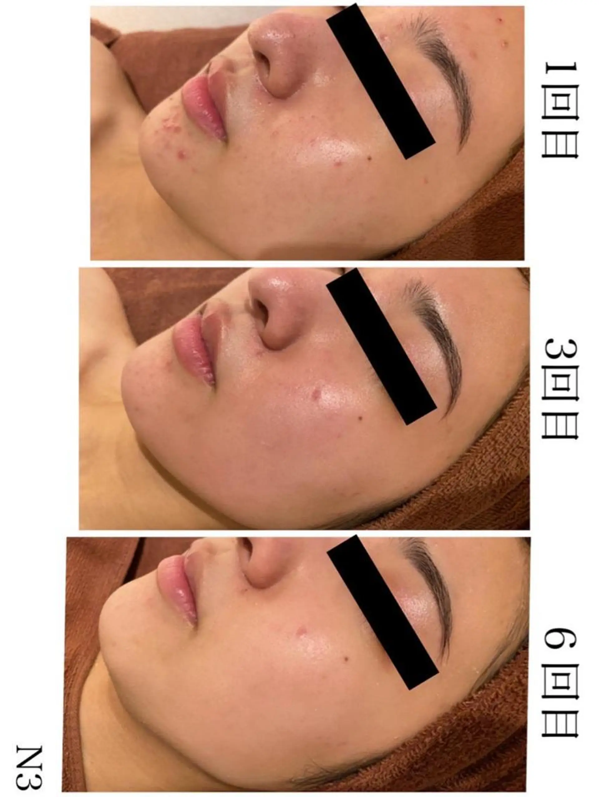 ニキビ特化型エステ 🍓最短で肌質改善のエステ・リラクイメージ