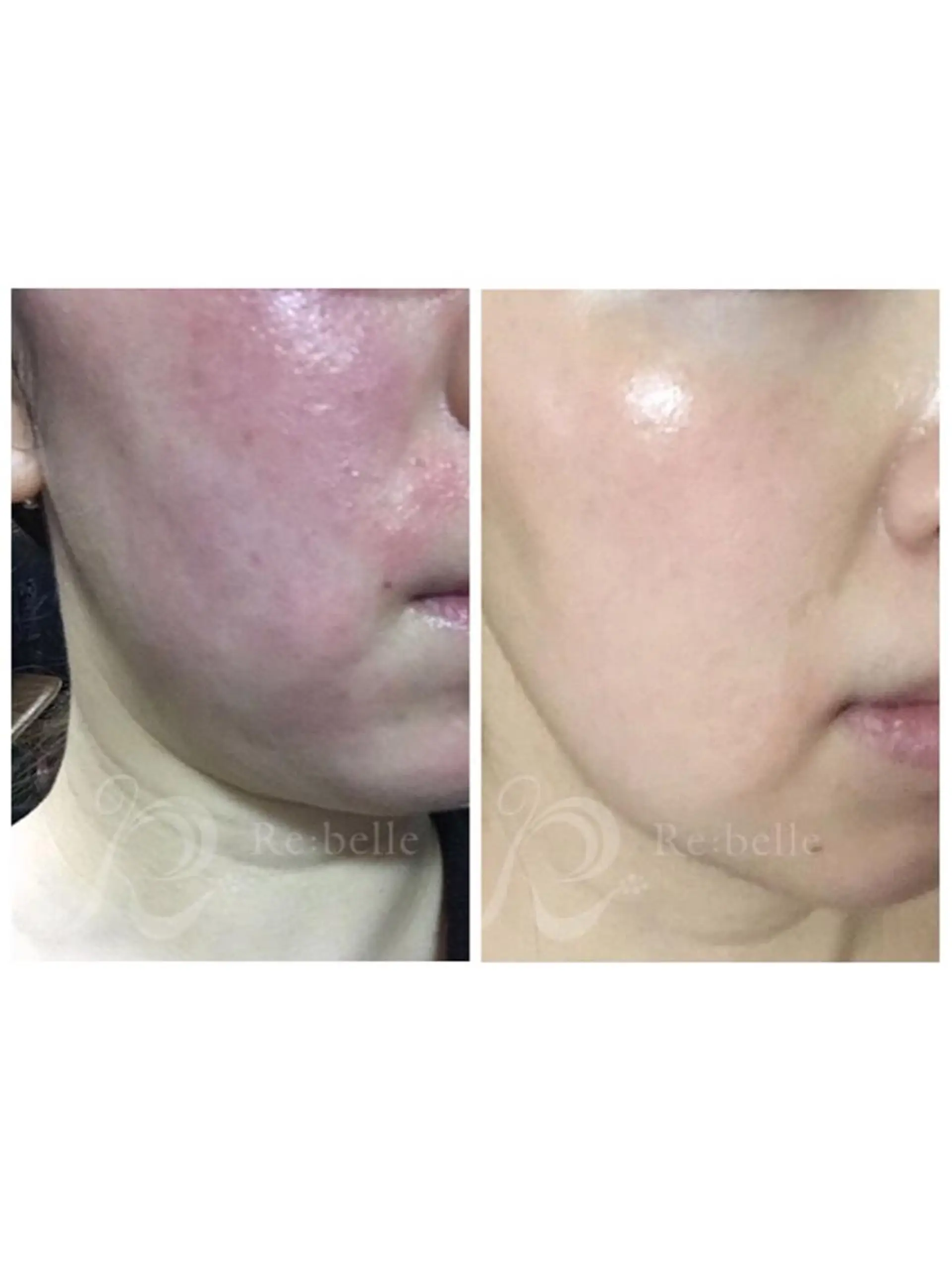 エステ 【リベルハーブピーリング認定店】敏感肌・美白脱毛専門店Dione立川店所属・Dione 立川店のエステ・リラクイメージ