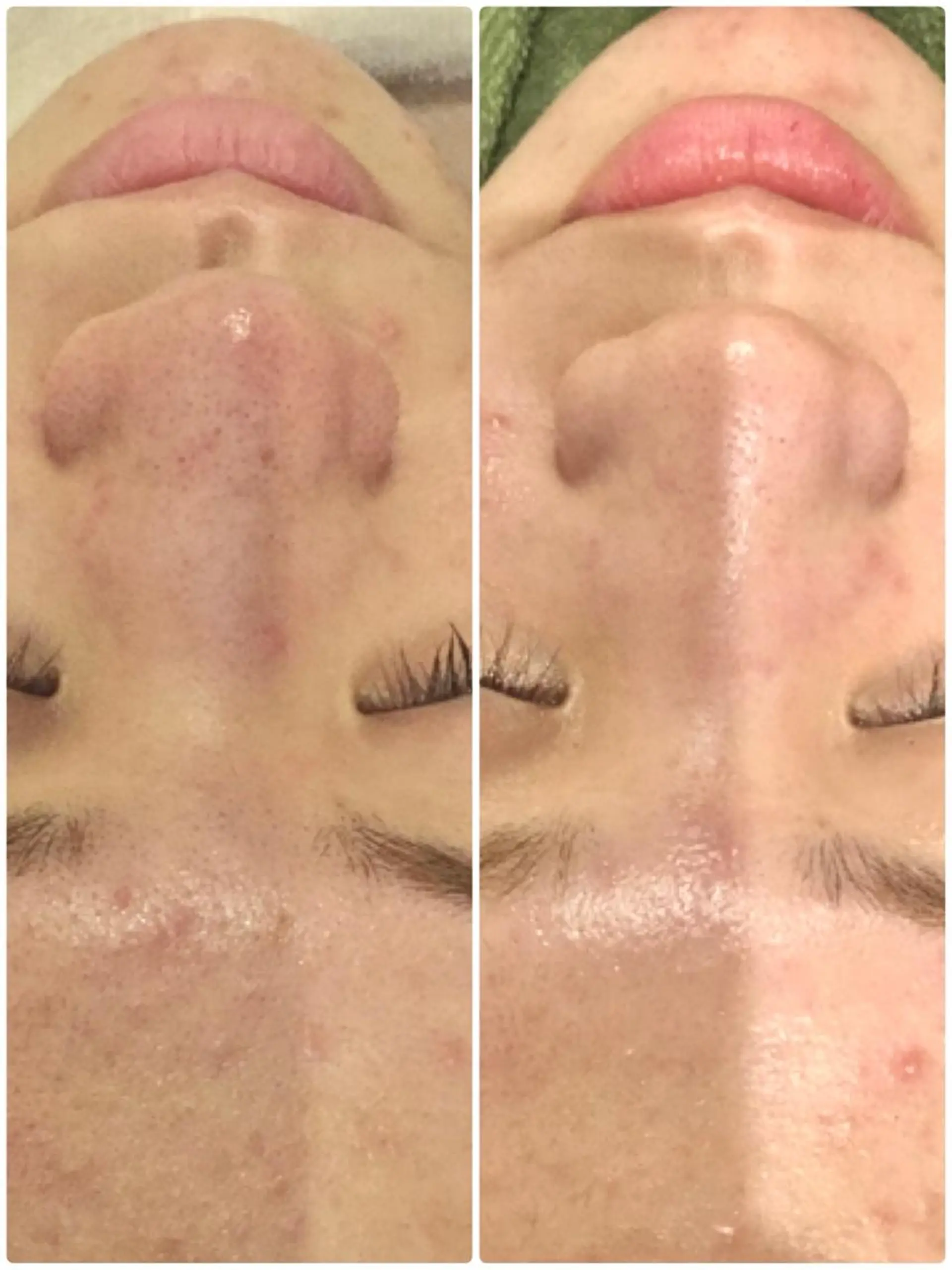 エステ 【リベルハーブピーリング認定店】敏感肌・美白脱毛専門店Dione立川店所属・Dione 立川店のエステ・リラクイメージ