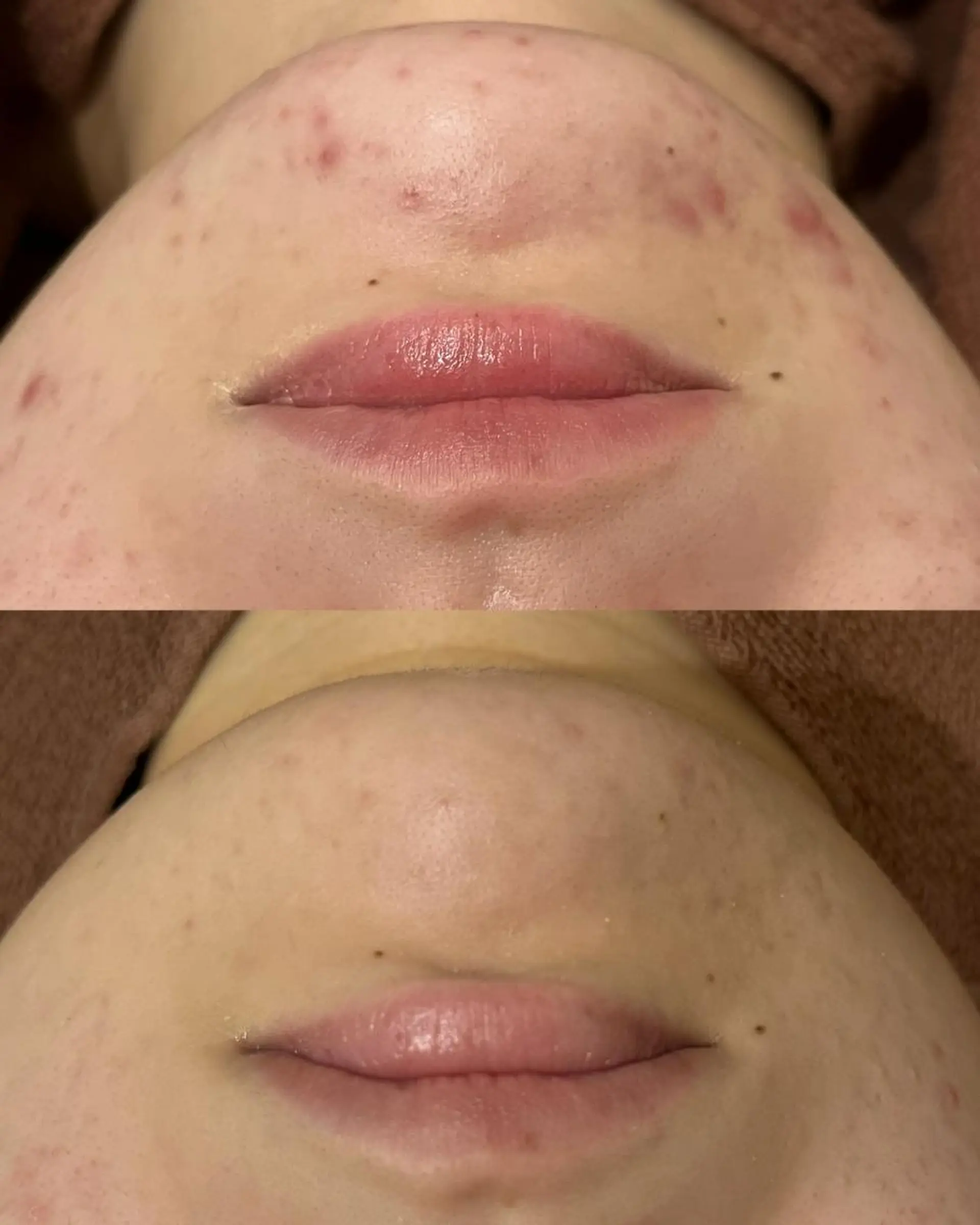 都内で出来る肌管理! 最短ニキビ改善のエステ・リラクイメージ