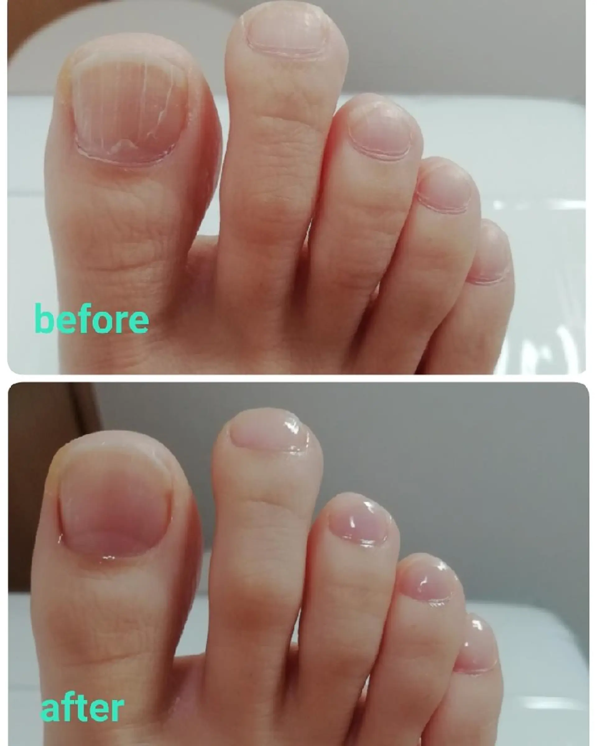 その他(ネイル) 巻き爪&フットケア レクーラのその他イメージ