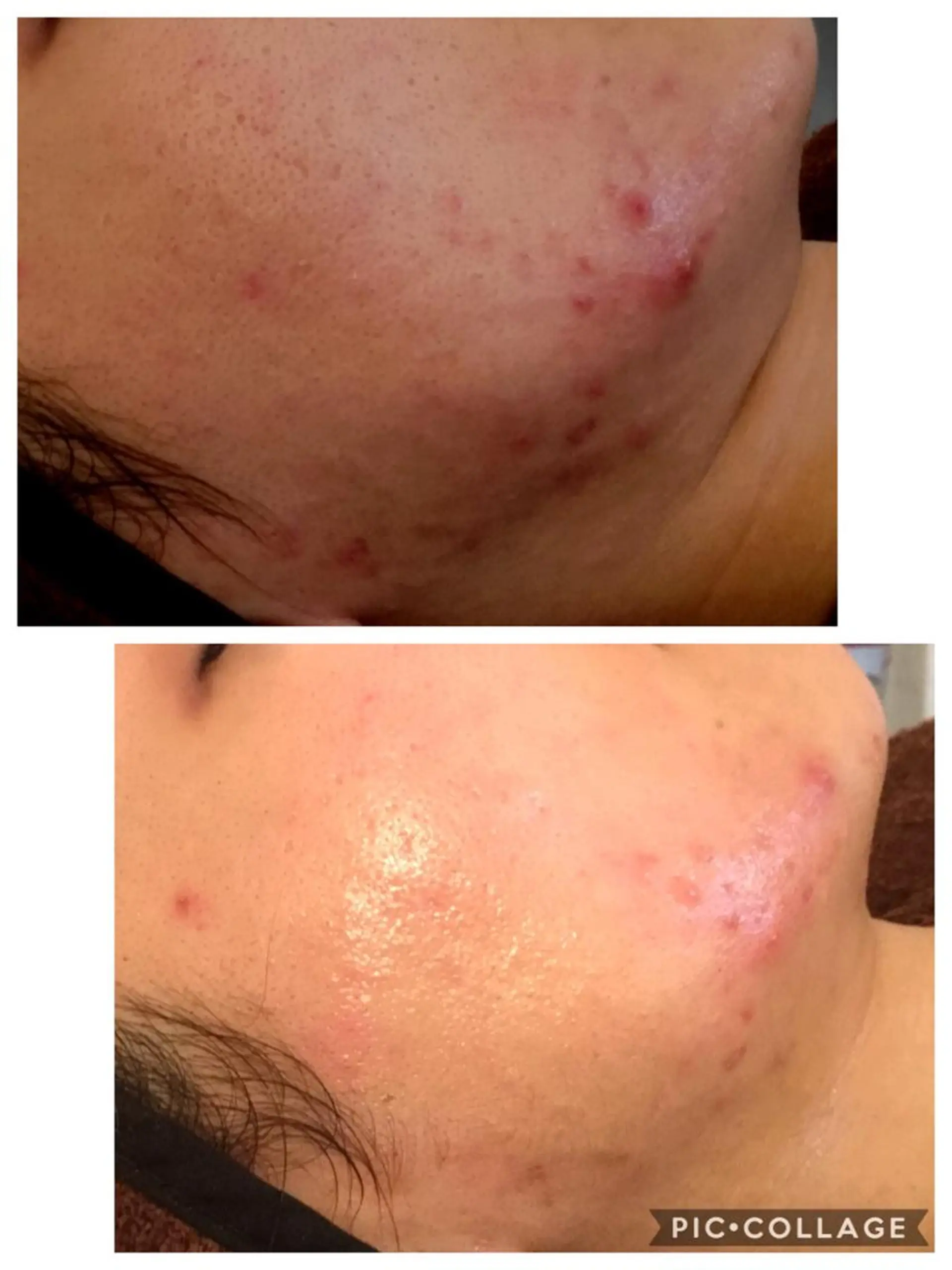 エステ リラク ニキビ/肌質改善専門 Snow skinのエステ・リラクイメージ