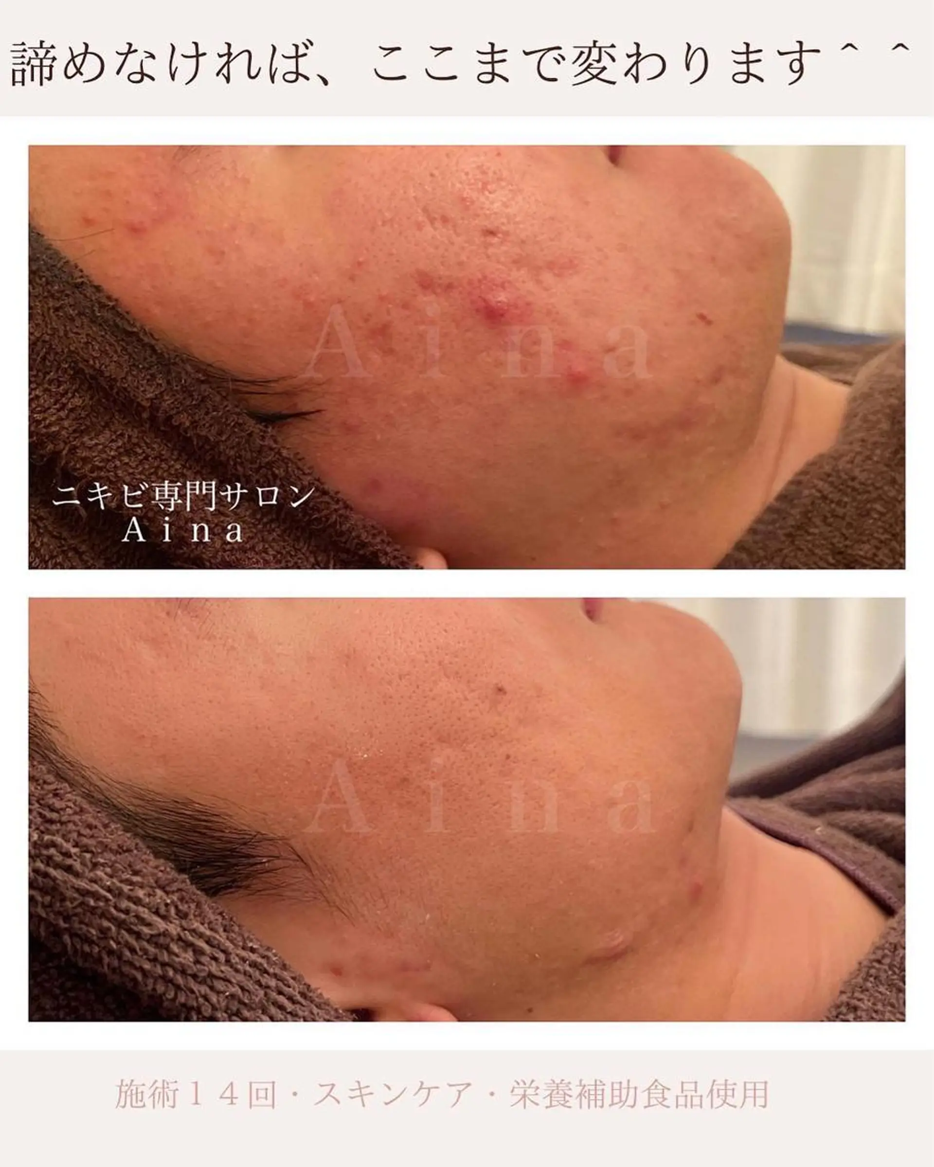 ミディアム エステ リラク ニキビ跡専門サロン Ａｉｎａのエステ・リラクイメージ