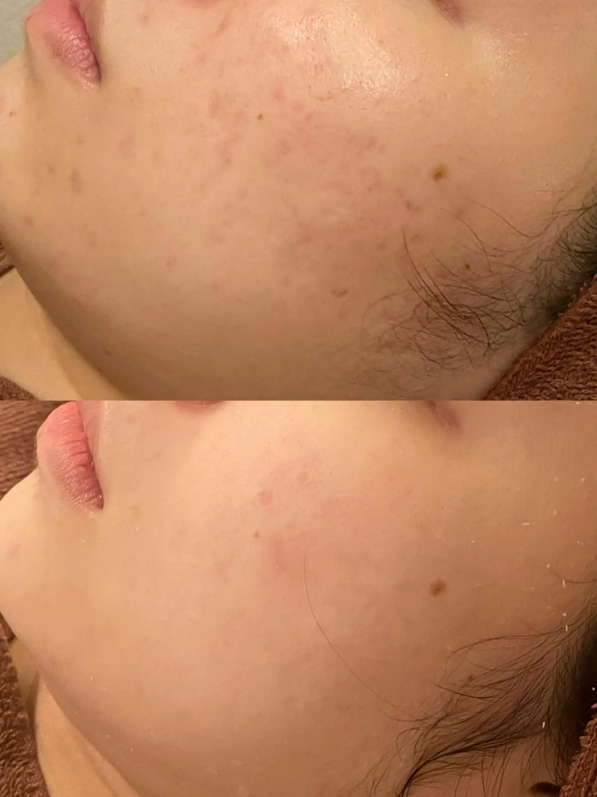 エステ リラク 夏までに肌荒れ卒業 するサロン🌻のエステ・リラクイメージ