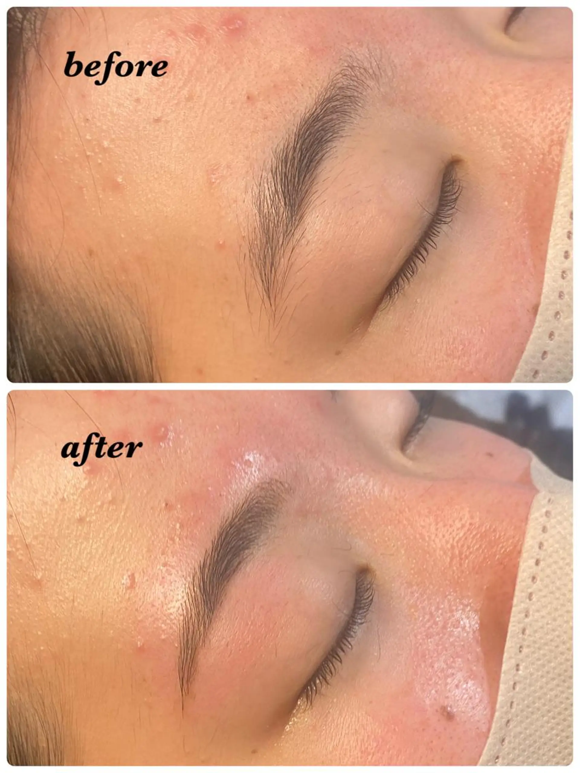 アイブロウ ハーブピーリング/韓国肌管理/フェイシャル/毛穴洗浄/眉毛/顔脱毛【糸脱毛専門】rev所属・ハーブピーリング🌹 毛穴洗浄❤️眉waxのエステ・リラクイメージ