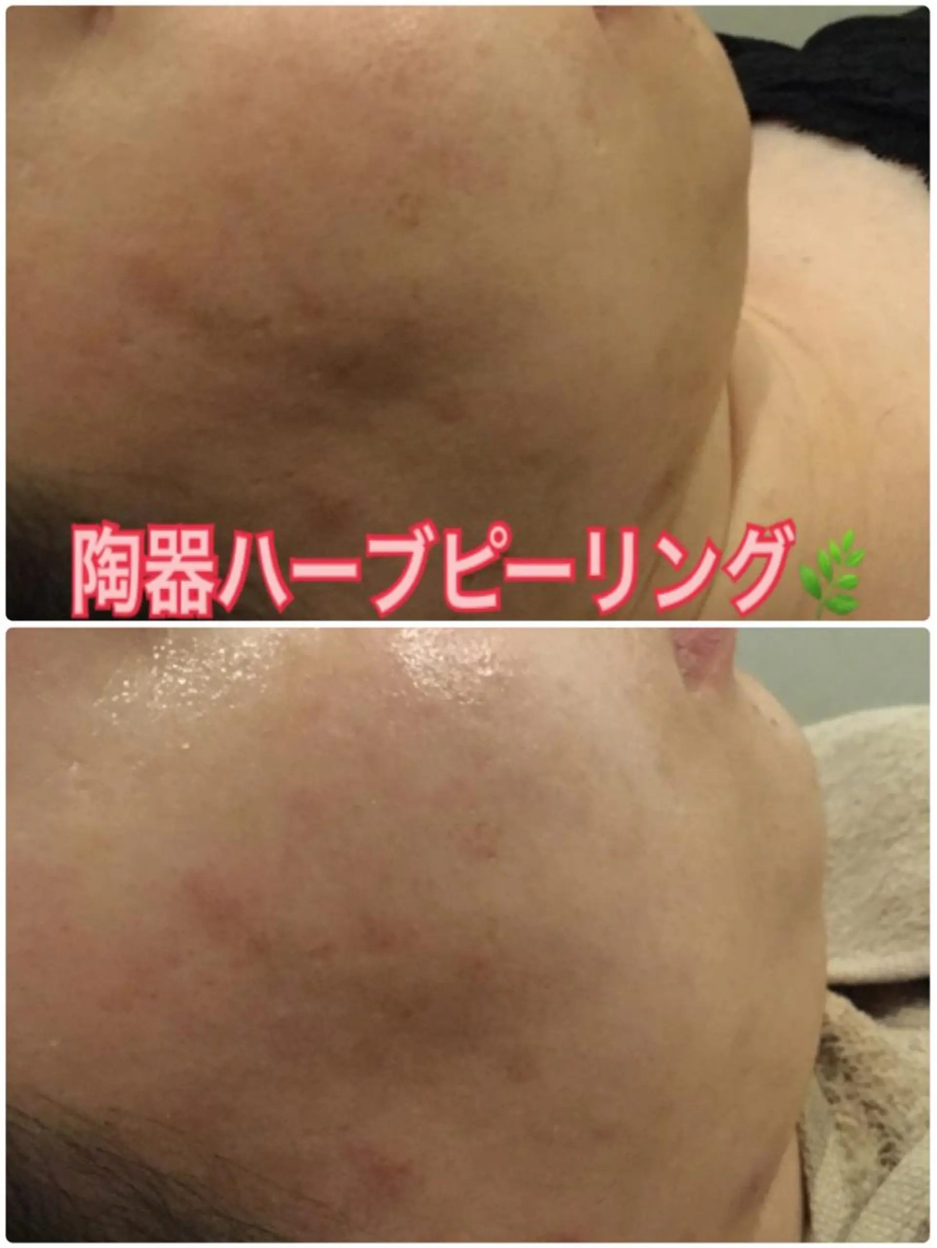 エステ 【リベルハーブピーリング認定店】敏感肌・美白脱毛専門店Dione立川店所属・Dione 立川店のエステ・リラクイメージ