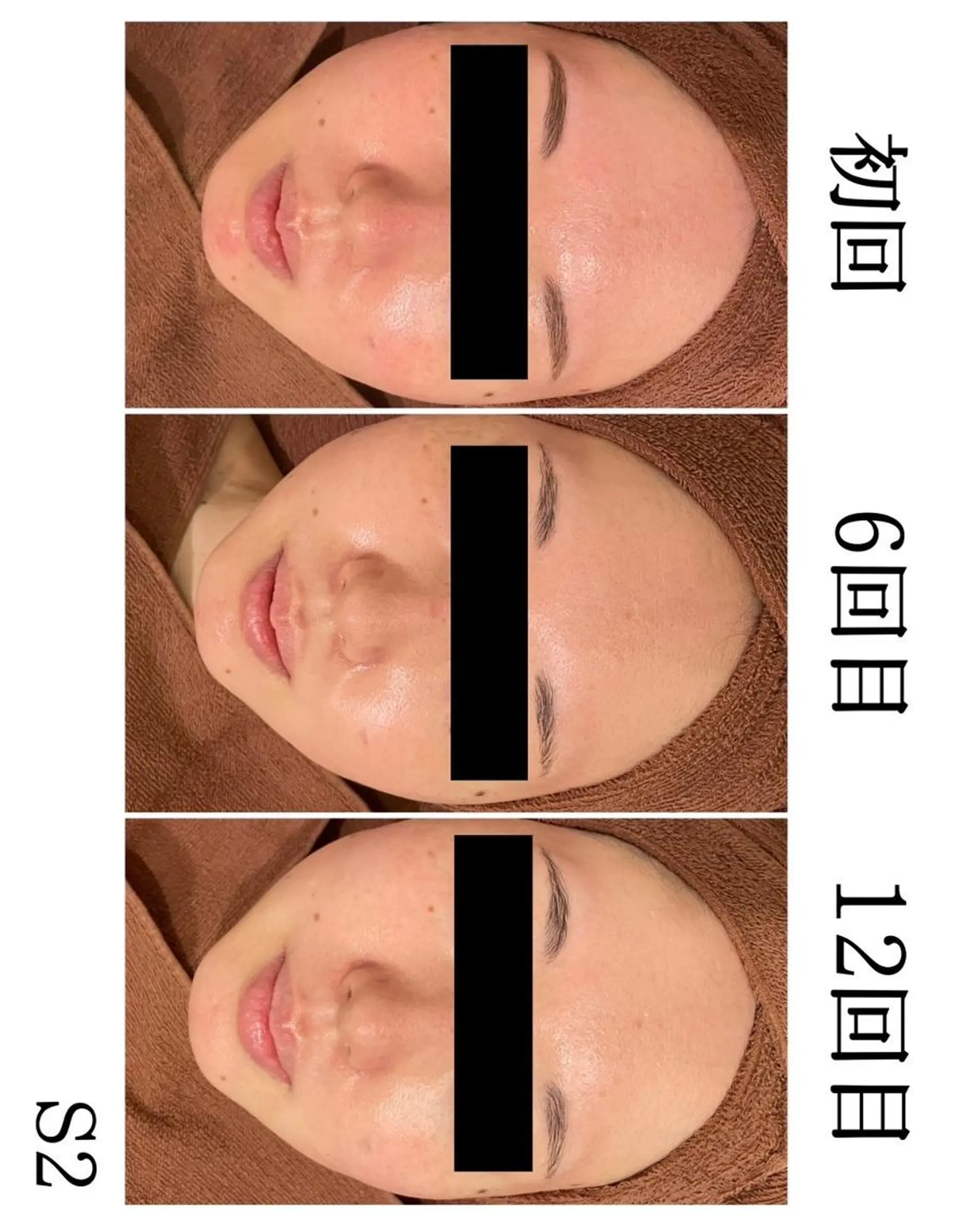 エステ リラク ニキビ特化型エステ 🍓最短で肌質改善のその他イメージ