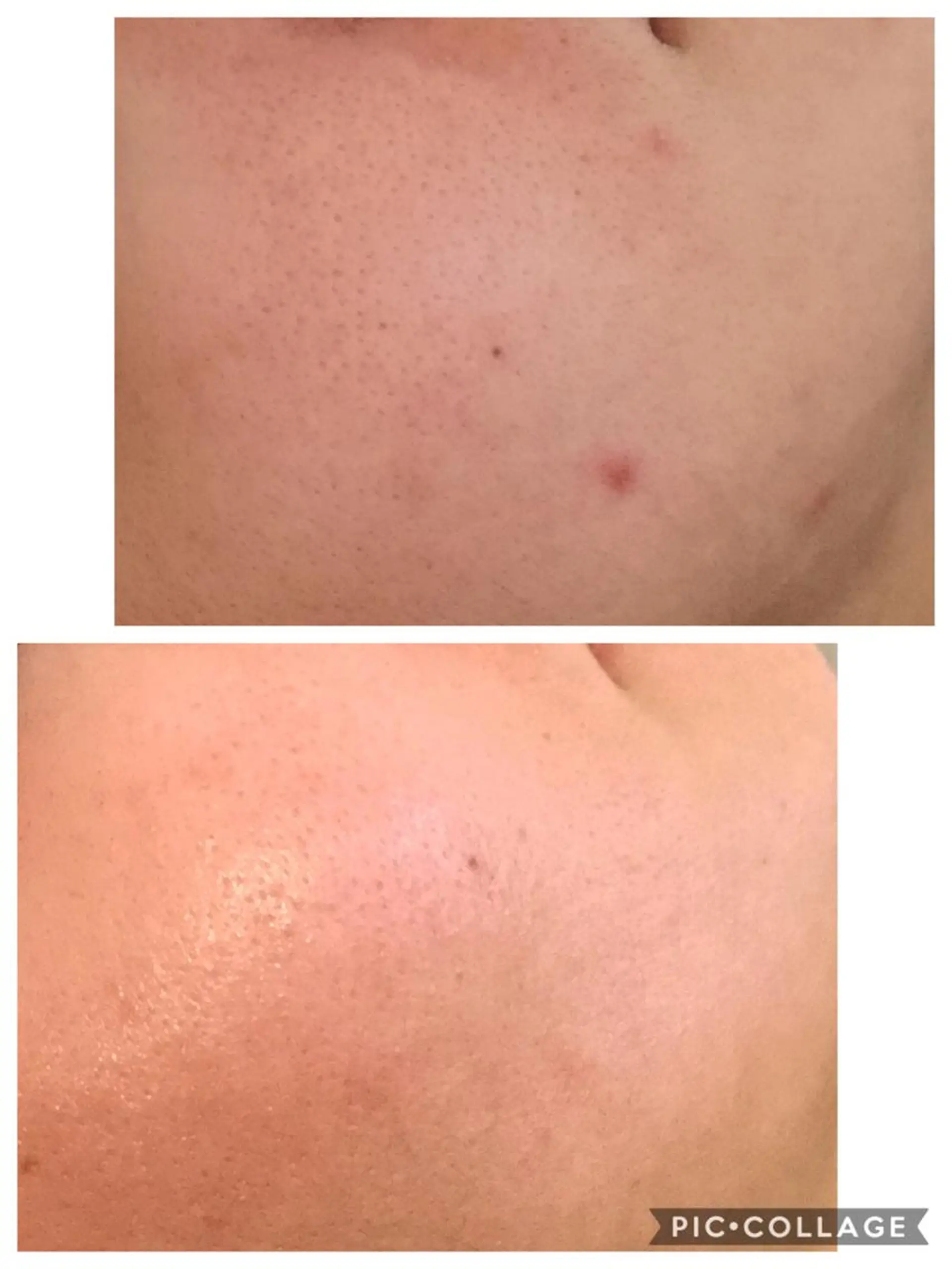 エステ リラク ニキビ/肌質改善専門 Snow skinのエステ・リラクイメージ