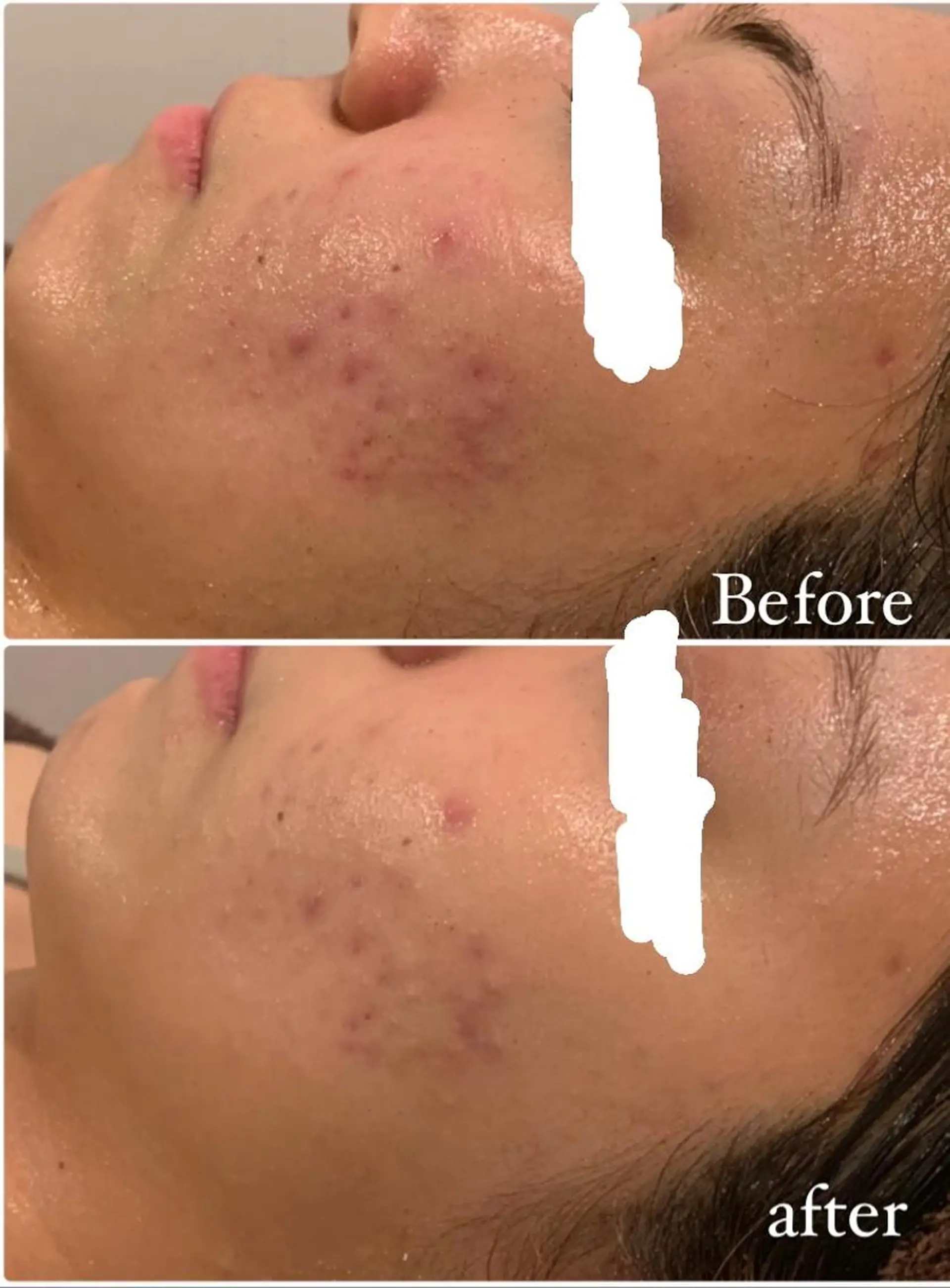 肌質改善ハーブピー リング🌿RINAのエステ・リラクイメージ