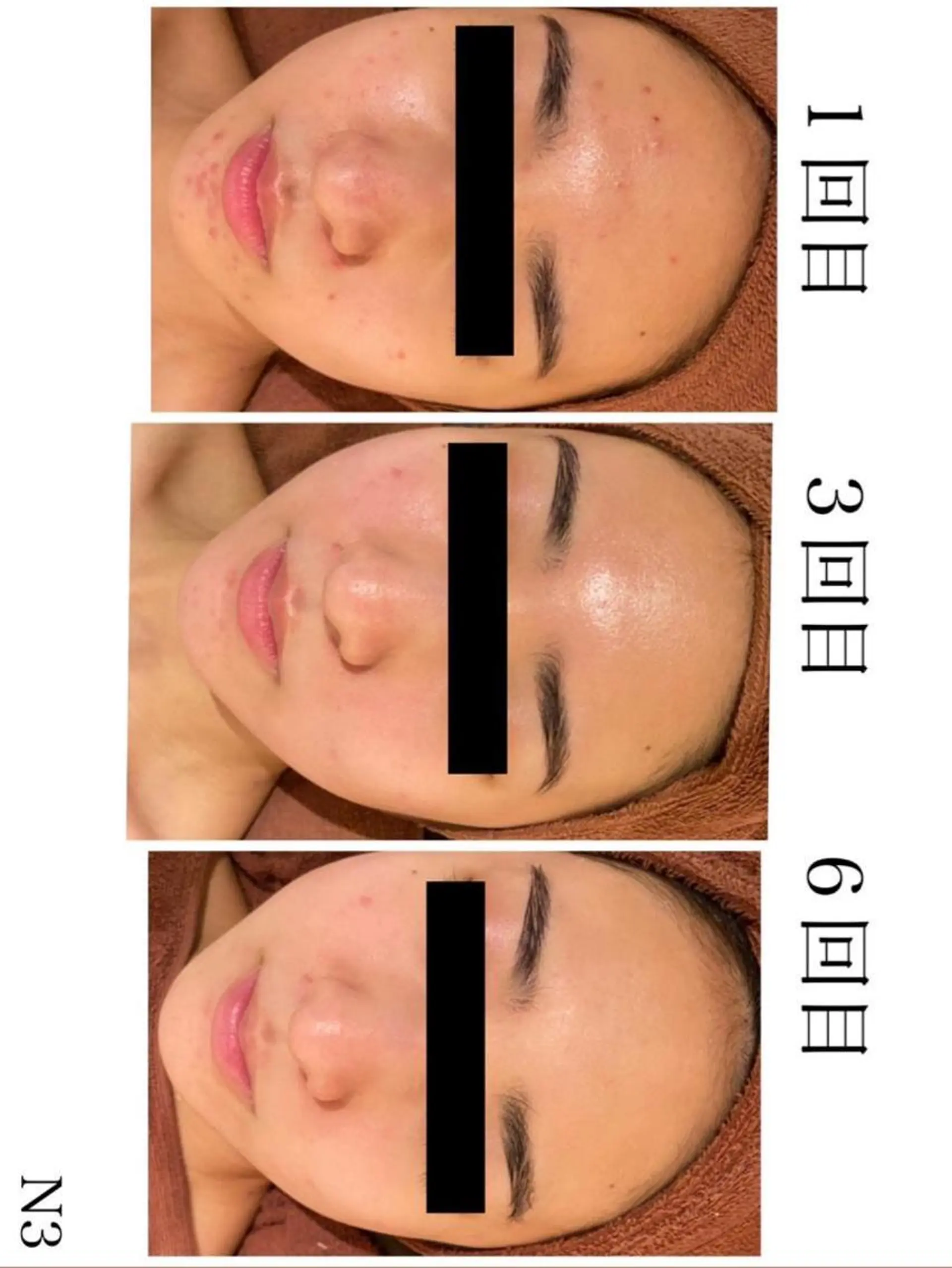 🔥3か月で肌革命 🔥ニキビ専門店のエステ・リラクイメージ